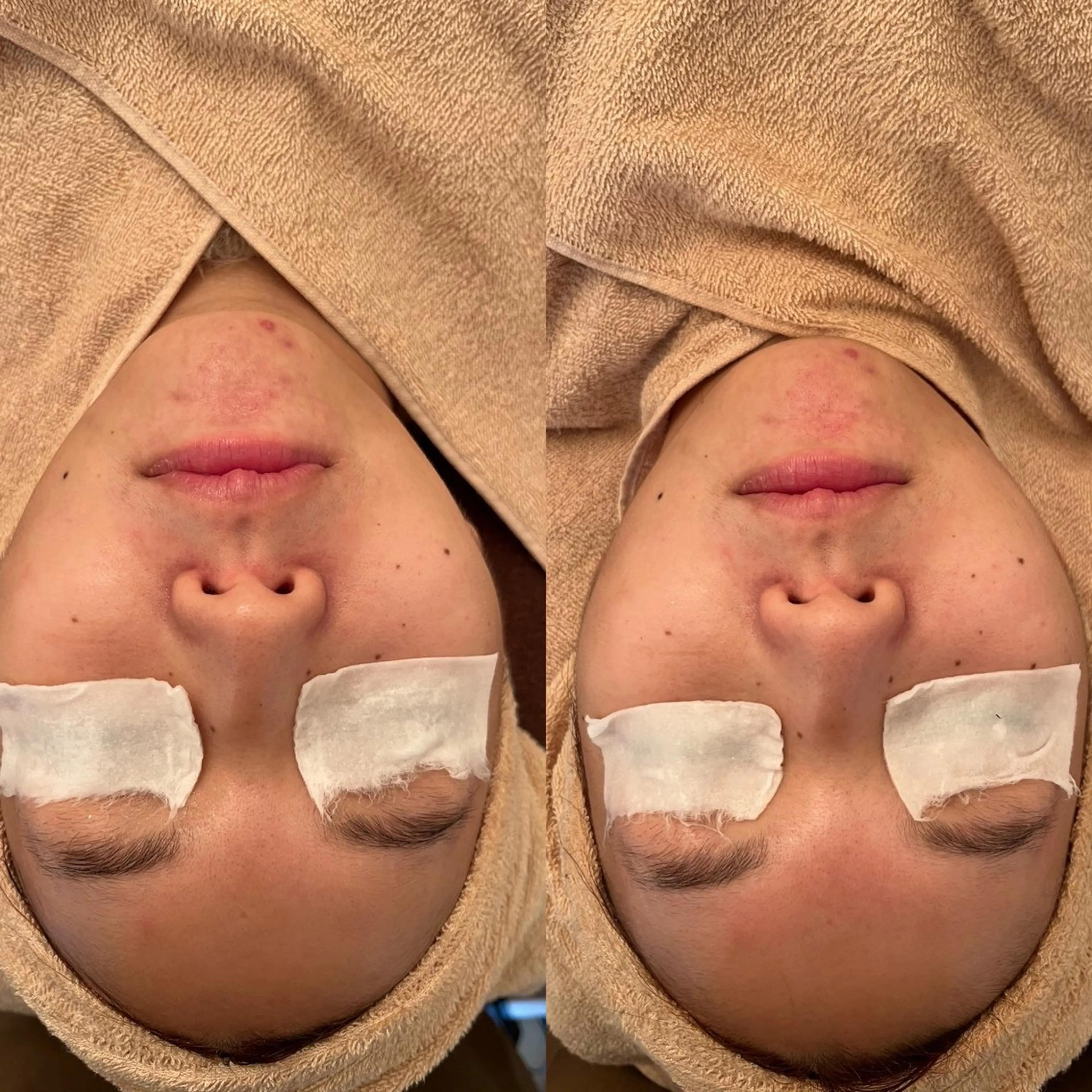 毛穴ケア/毛穴診断/ 毛穴洗浄〔心斎橋〕のエステ・リラクイメージ