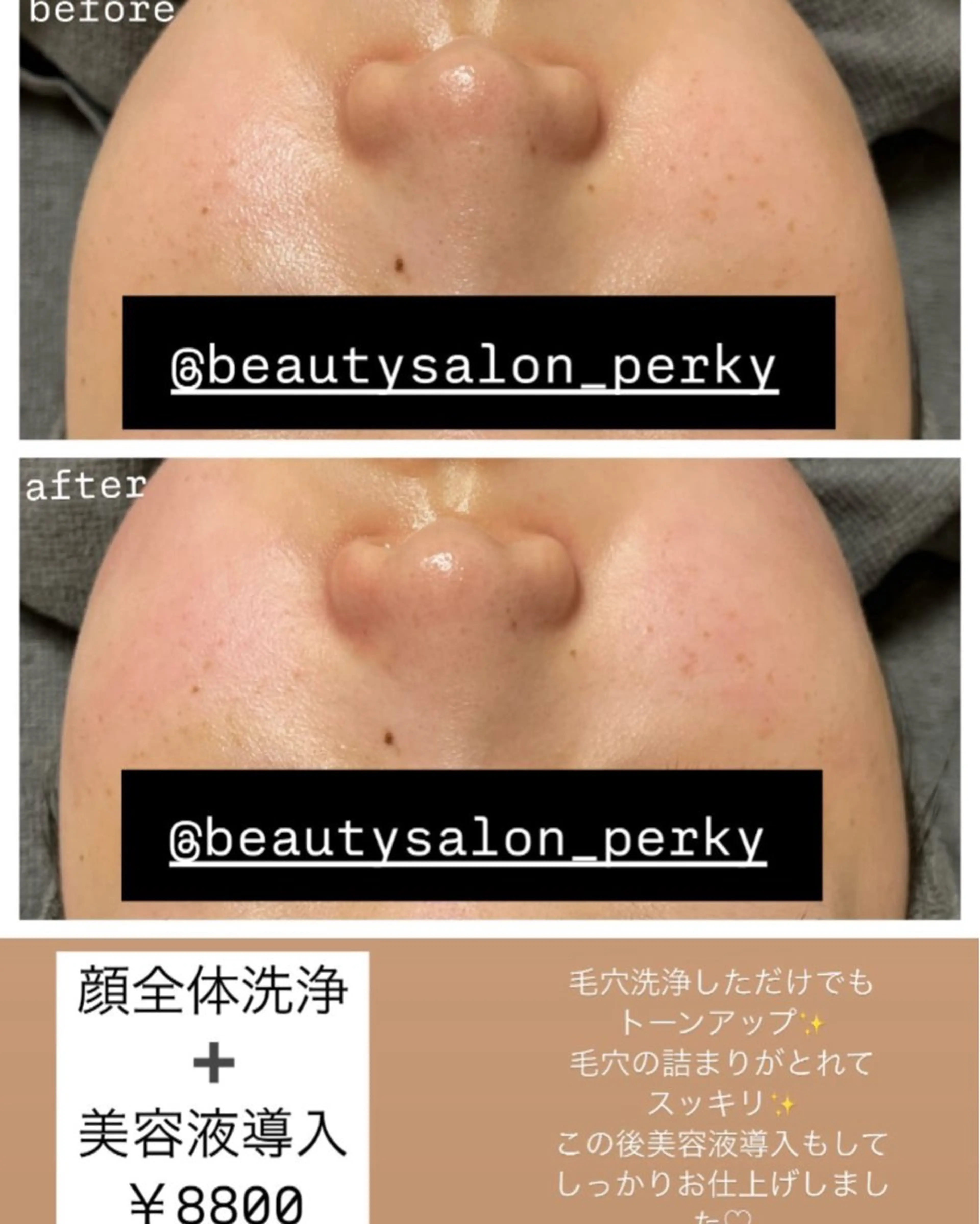 【ダウンタイム・剥離なし⠀】ハイドラフェイシャル・水流ピーリング・美容液導入の写真