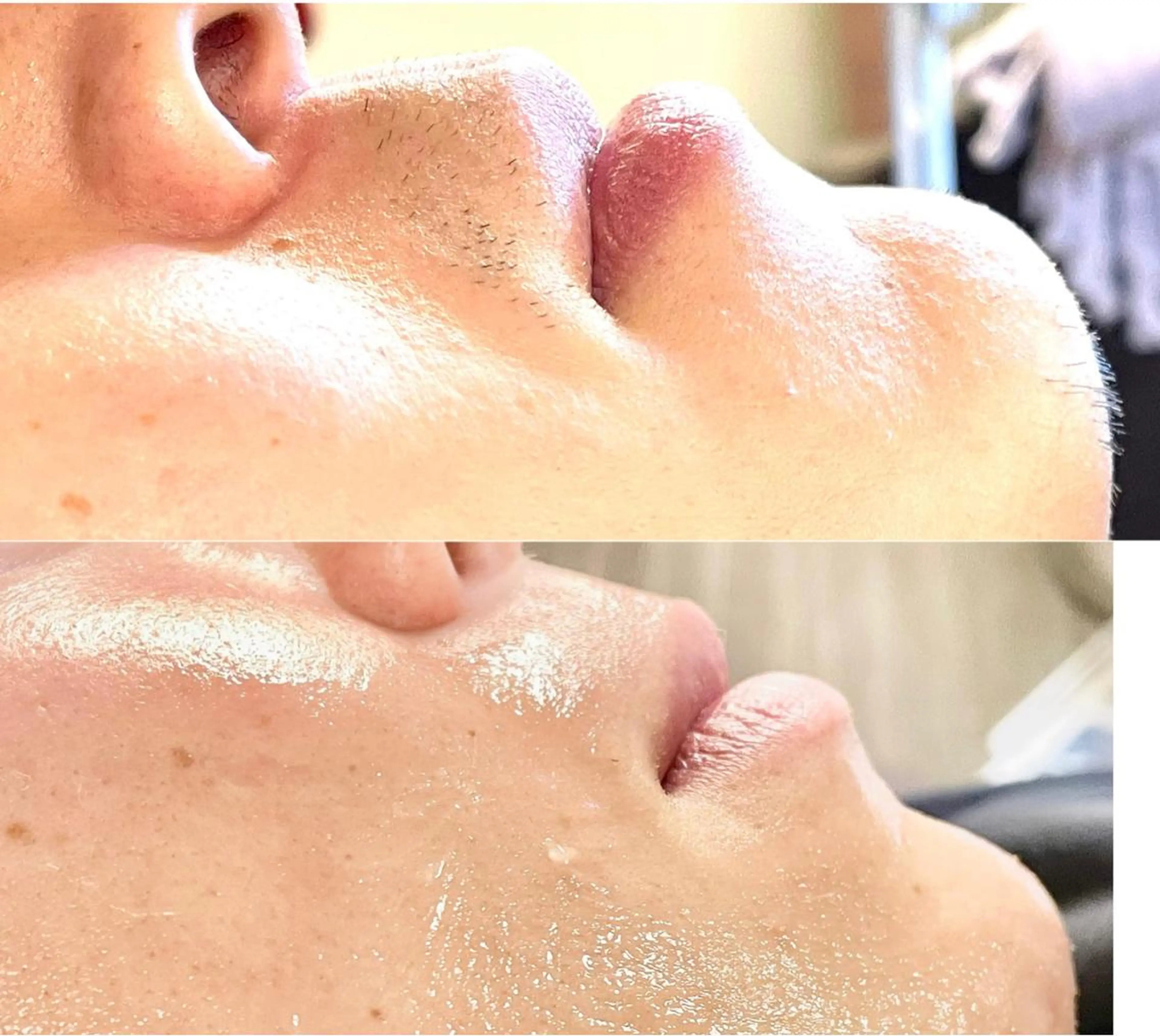 メンズ🥸【髭WAX脱毛】の写真