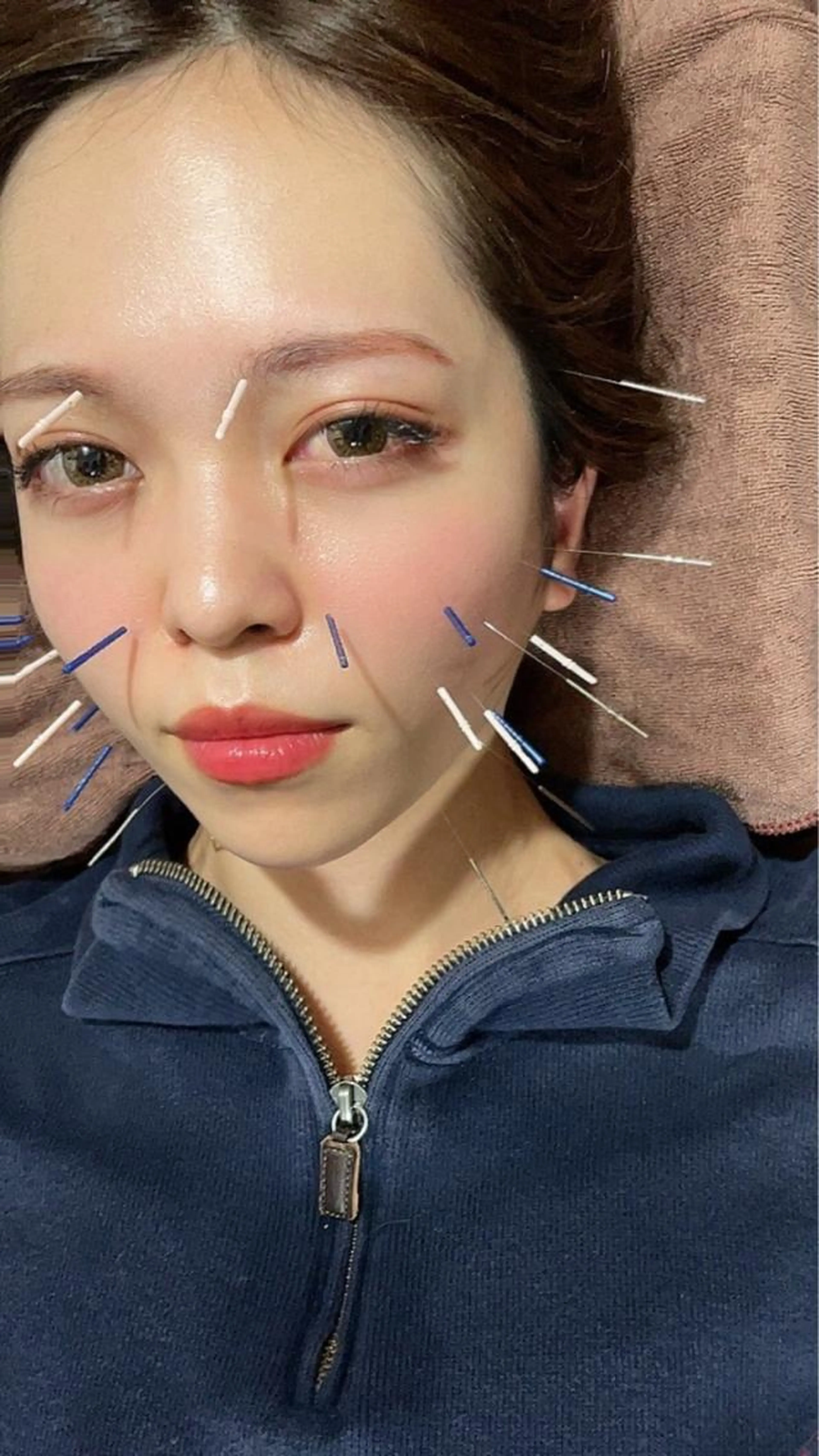 ✨小顔実感✨美容鍼＋小顔矯正＋首肩リンパマッサージの写真