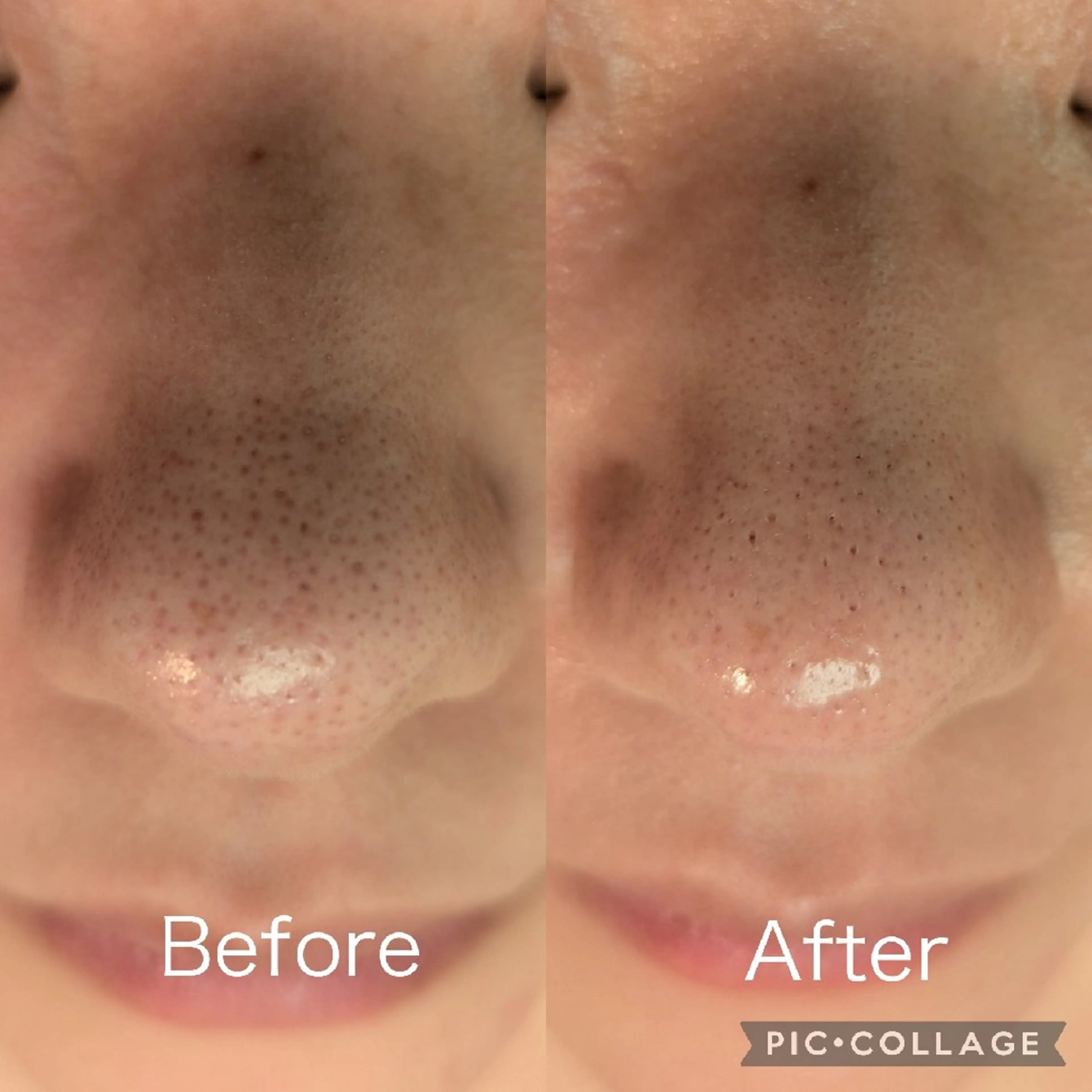 エステ 毛穴フェイシャルエステkokotto板橋所属・板橋美肌ハーブ ピーリング1位のエステ・リラクイメージ