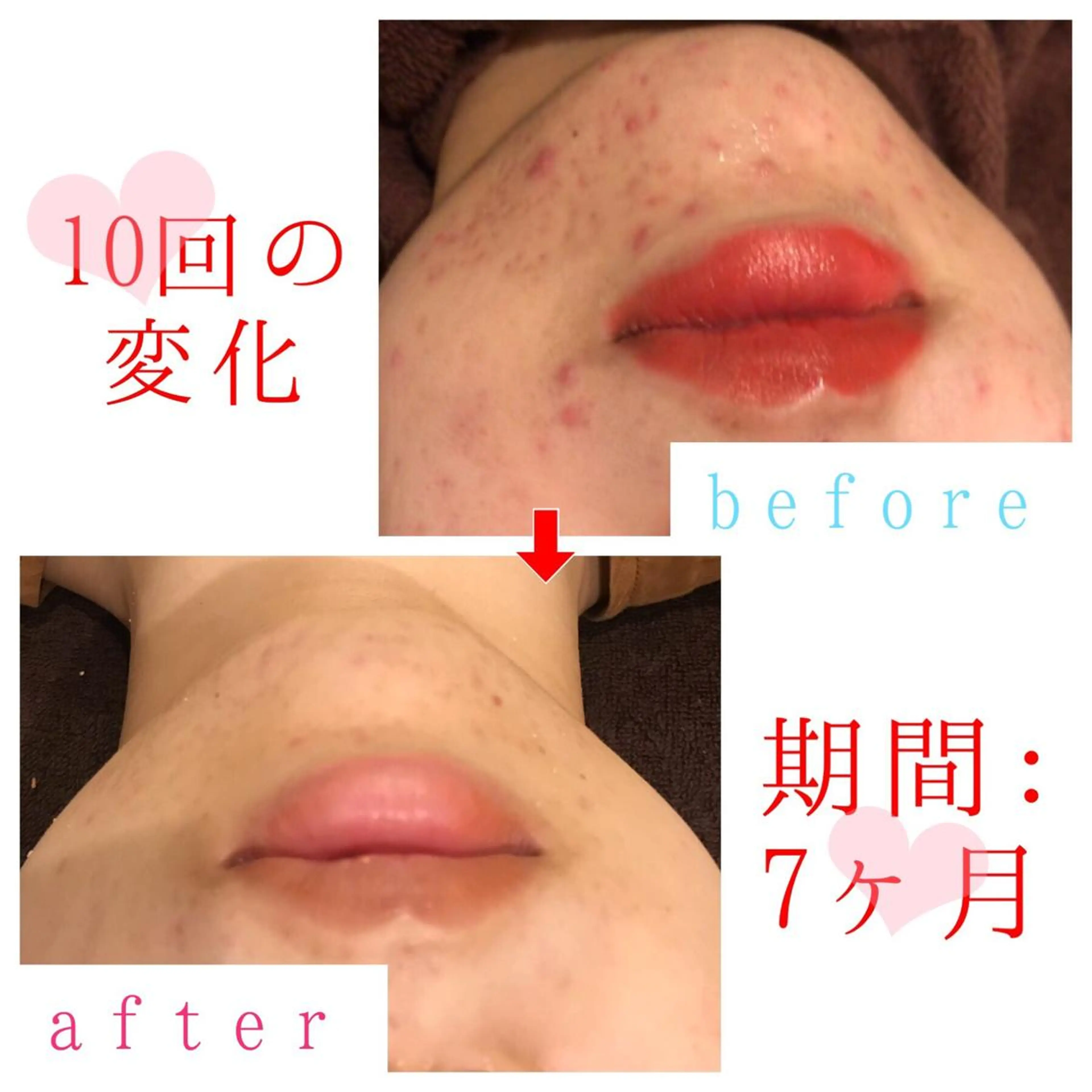 圧倒的効果(人気No.1💖ニキビ・毛穴に効果！温泉みつろつフェイシャル )　＋　(話題沸騰✨腸もみデトックス) 💎の写真