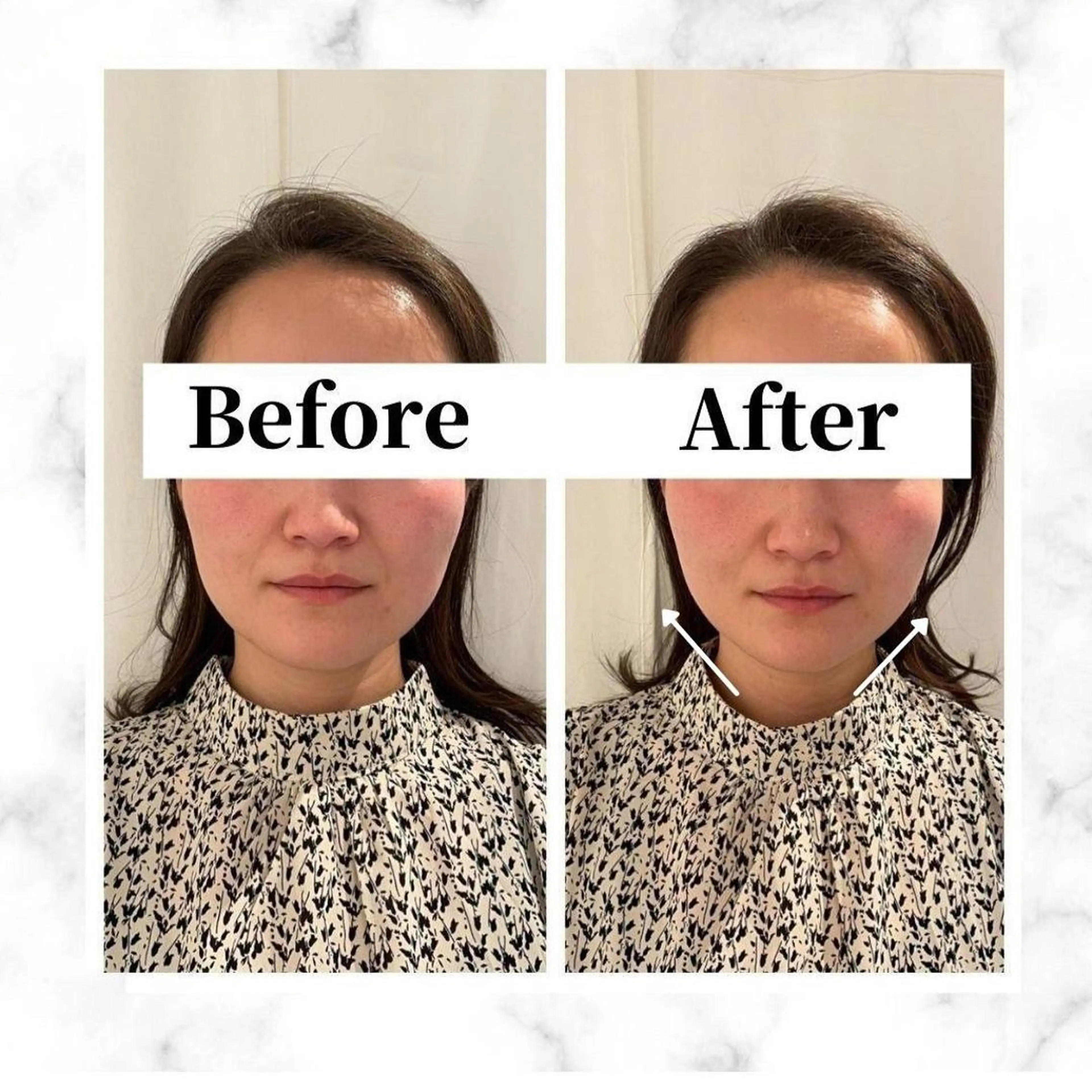 エステ リラク 12Dハイフ💗 最強小顔のエステ・リラクイメージ