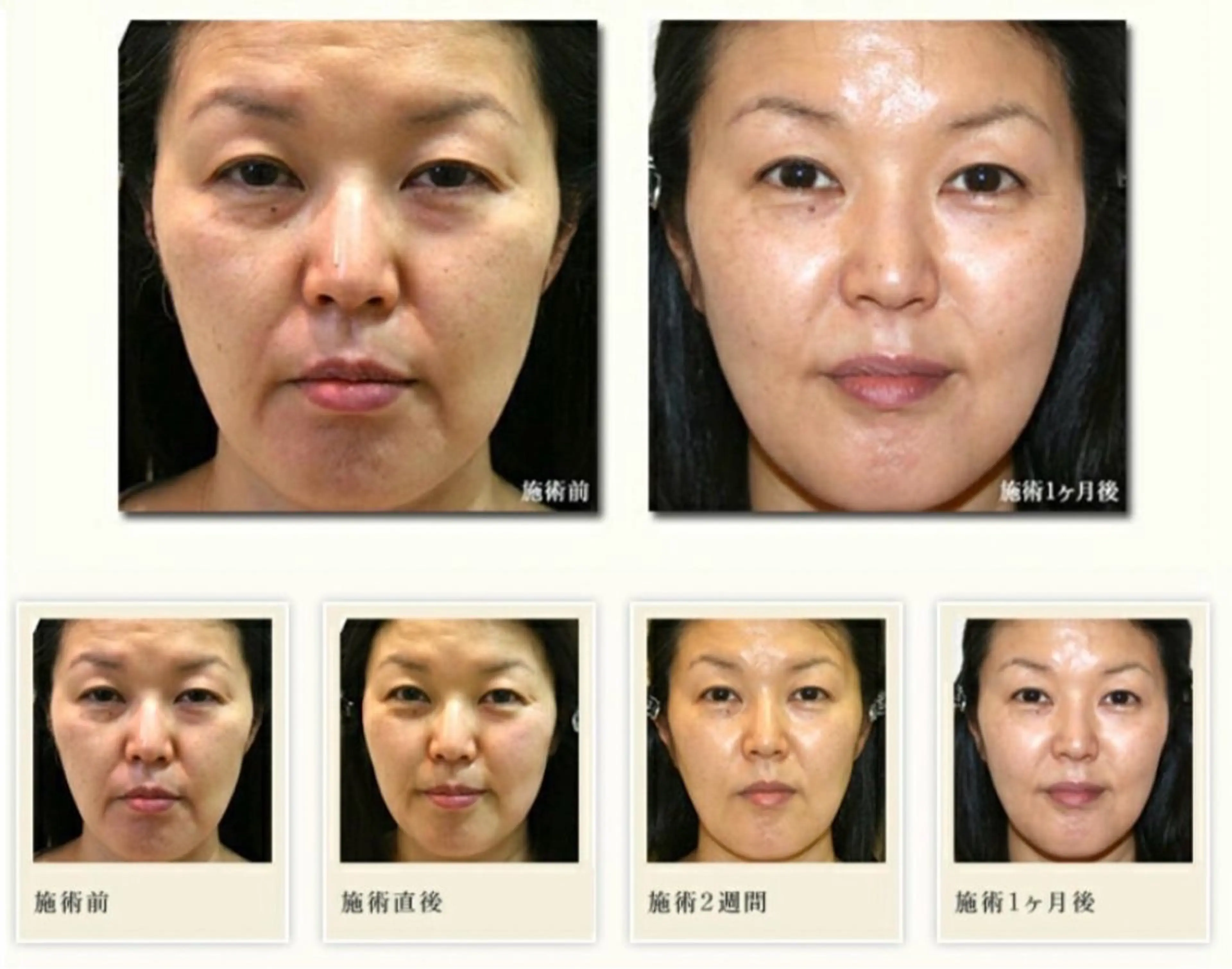 ［フェイシャルエステ］超音波＋ハイパーナイフ➕イオン導入の写真