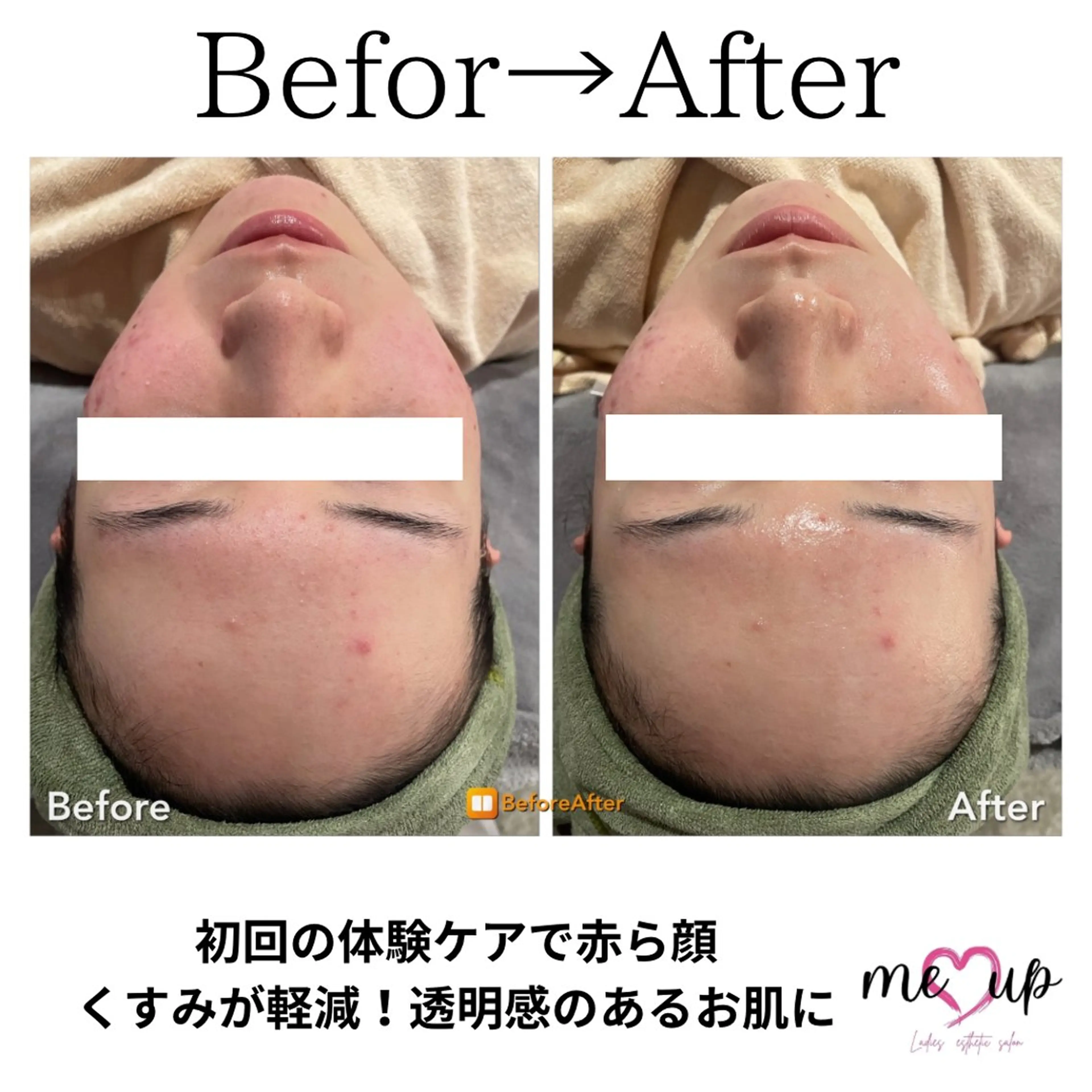 エステ Meupニキビ専門店 背中/ハーブ/肌管理のその他イメージ