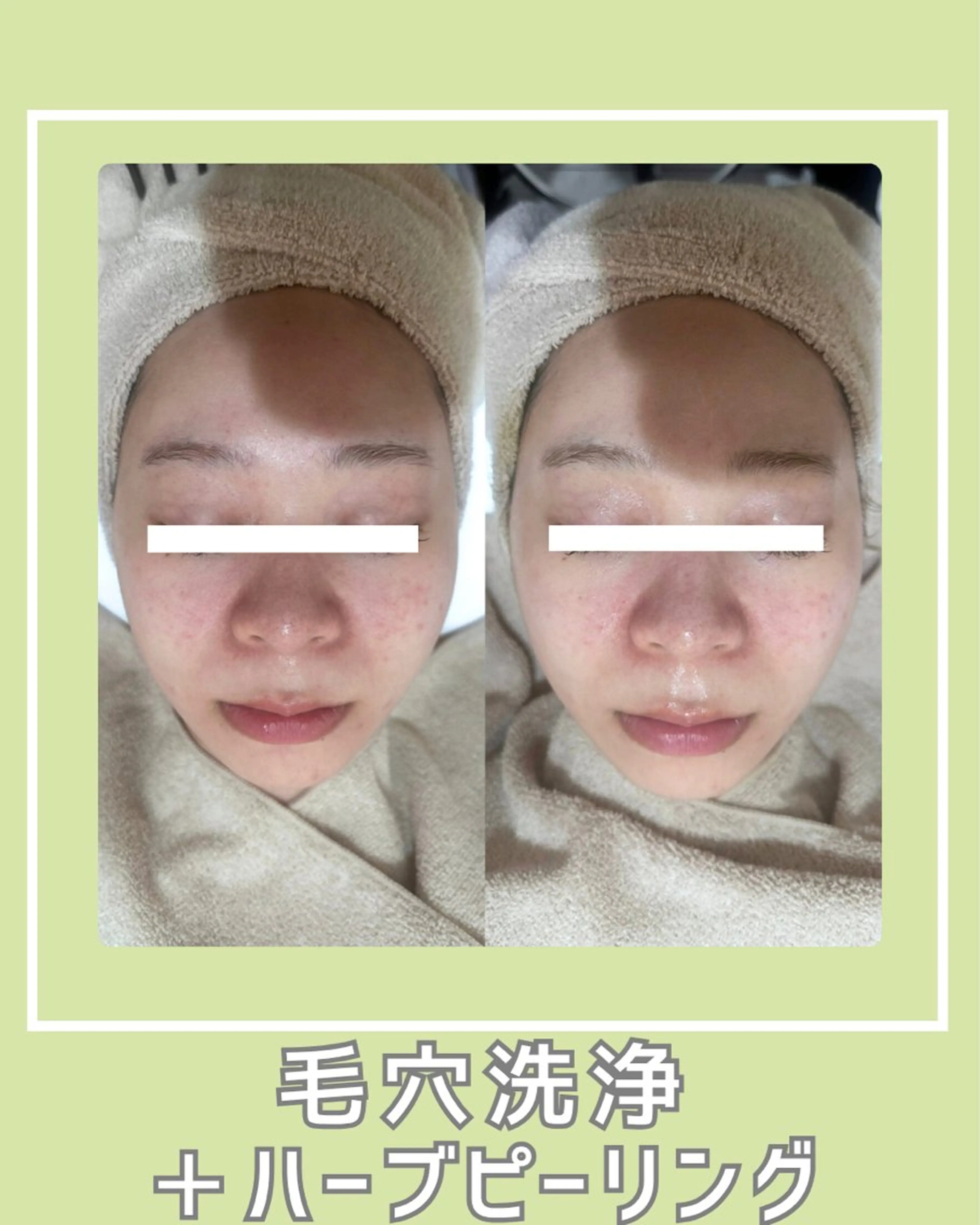 〈毛穴悩みに👃〉毛穴洗浄+ハーブピーリング(ダウンタイム&剥離なし)　70分14,000円の写真