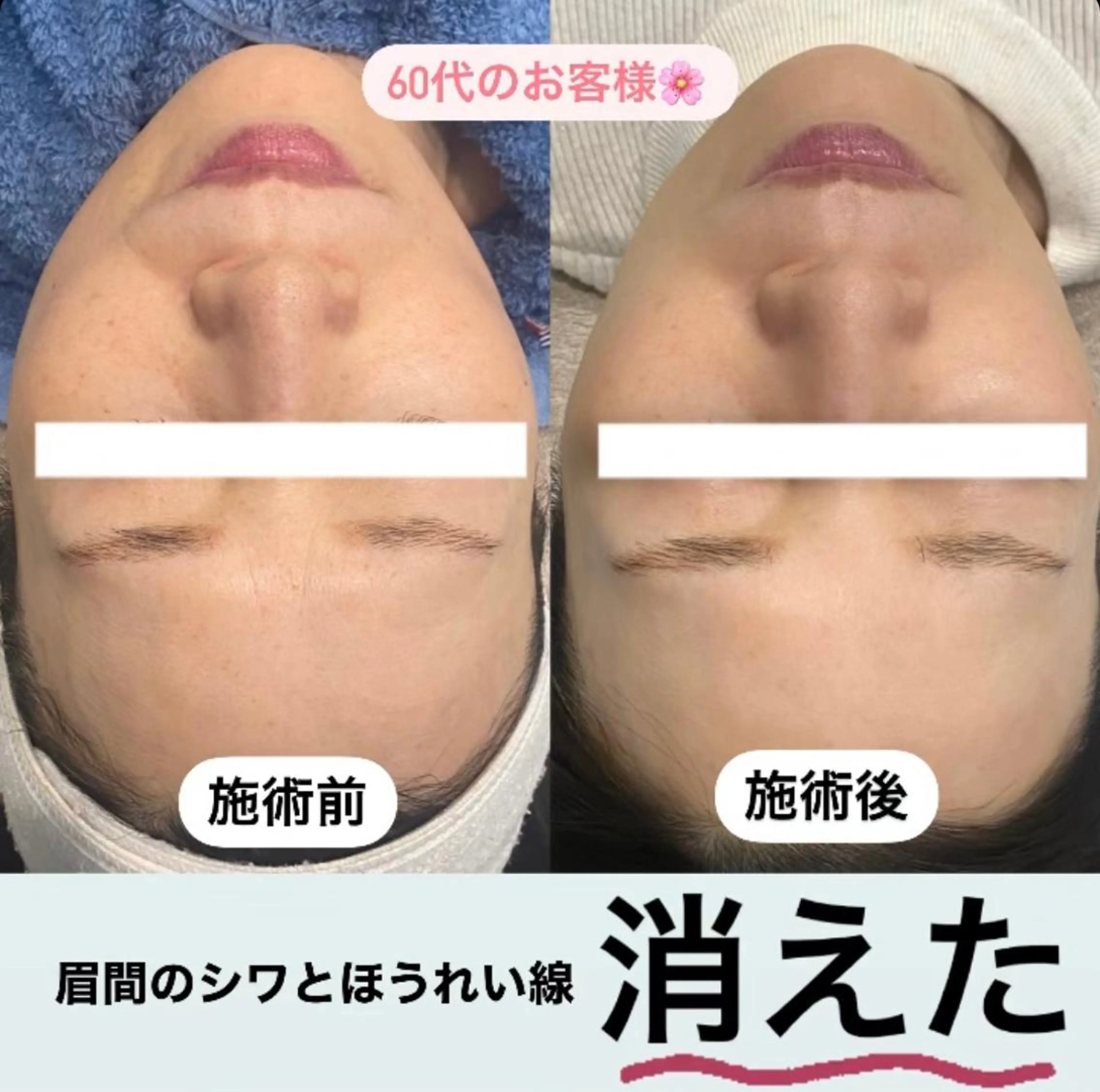 塗るボトックス💉✨海外で超話題 "針を使わないボトックス“【ゾンビマスク🧟‍♀️】整形級美肌を目指すならコレ‼️の写真