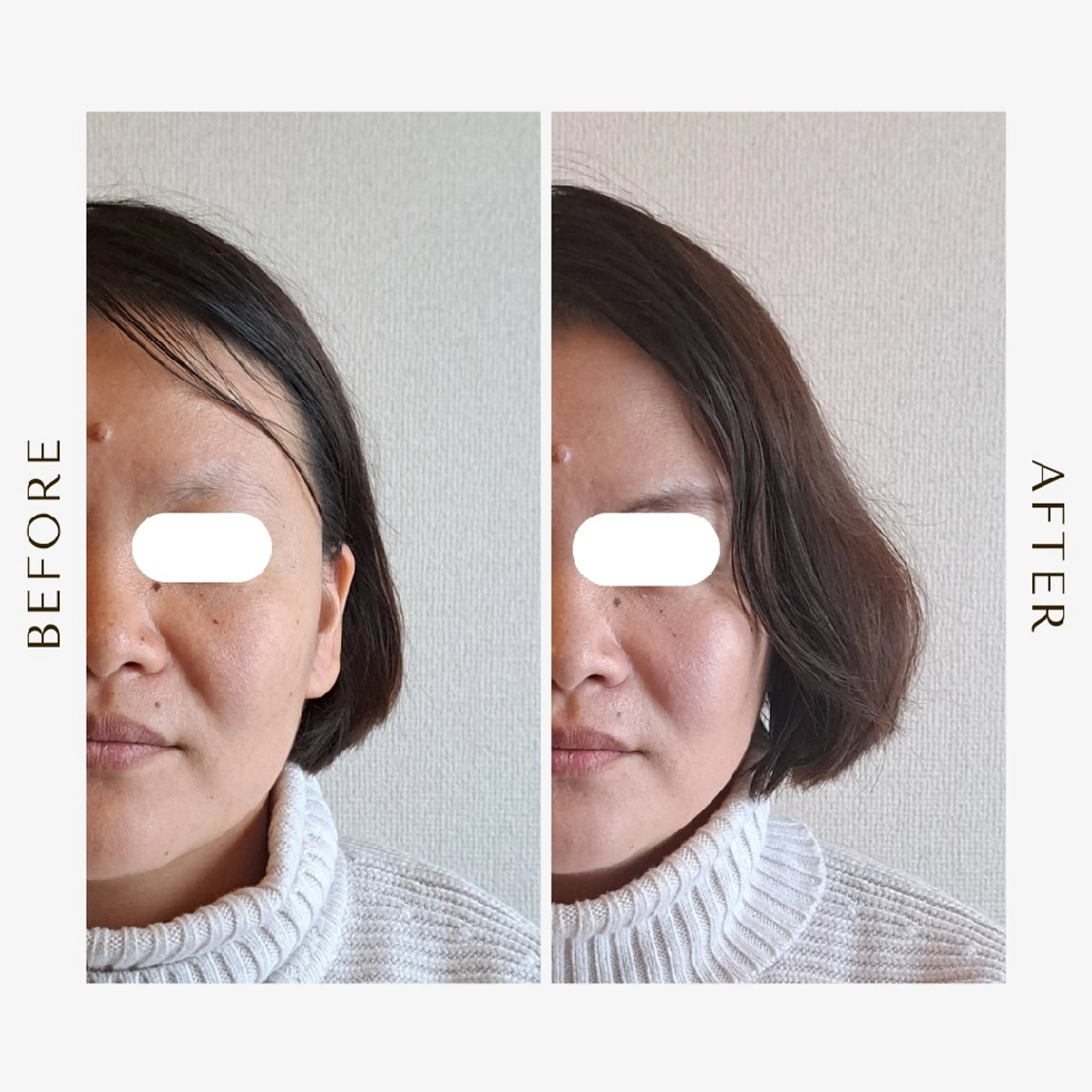 【当店人気No.2🏅鍼灸×エステ】小顔～身体・頭まで全身トータルケア🌠美容鍼ベーシック&鍼灸BODYコース140分の写真