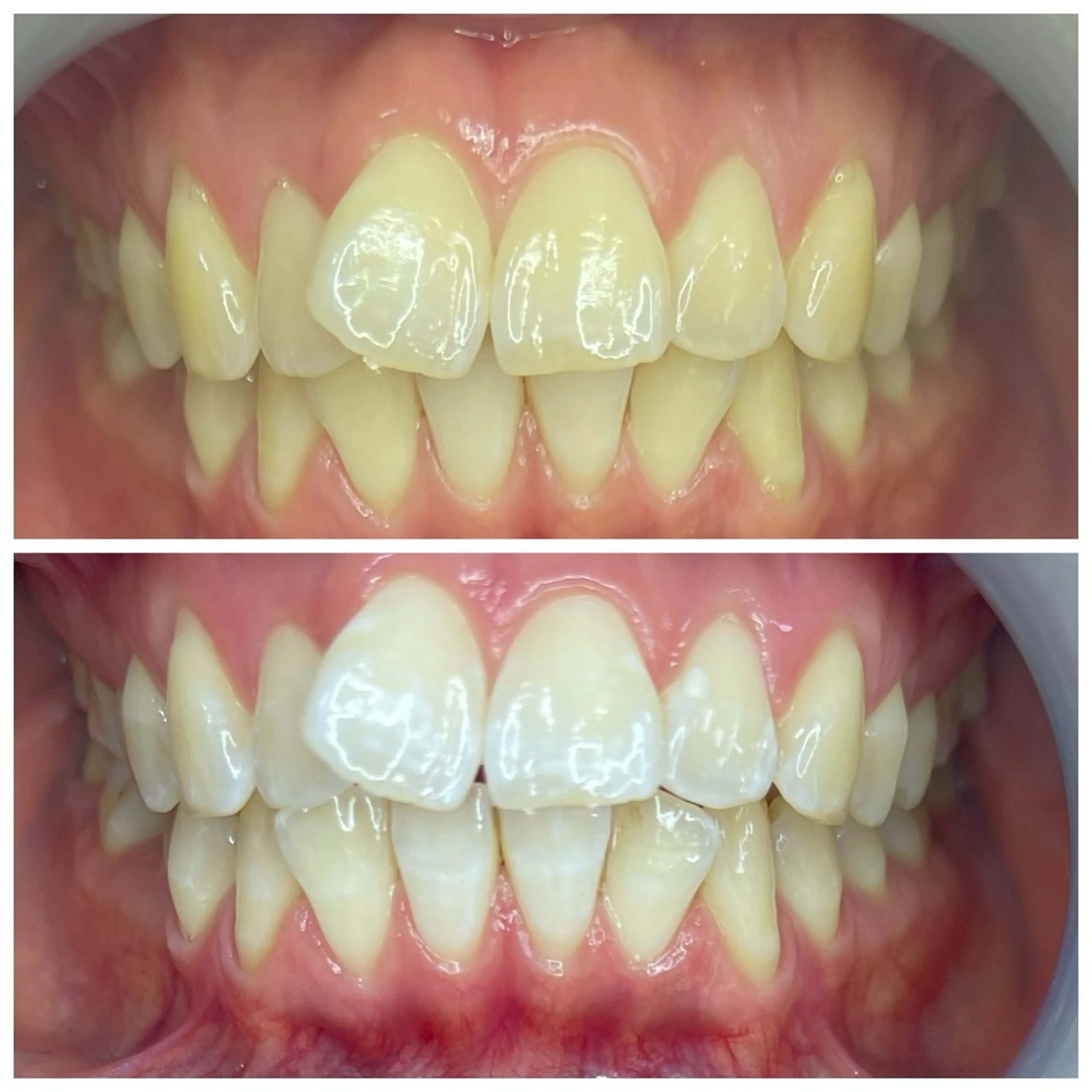 新規様10分×3回LEDホワイトニングの写真