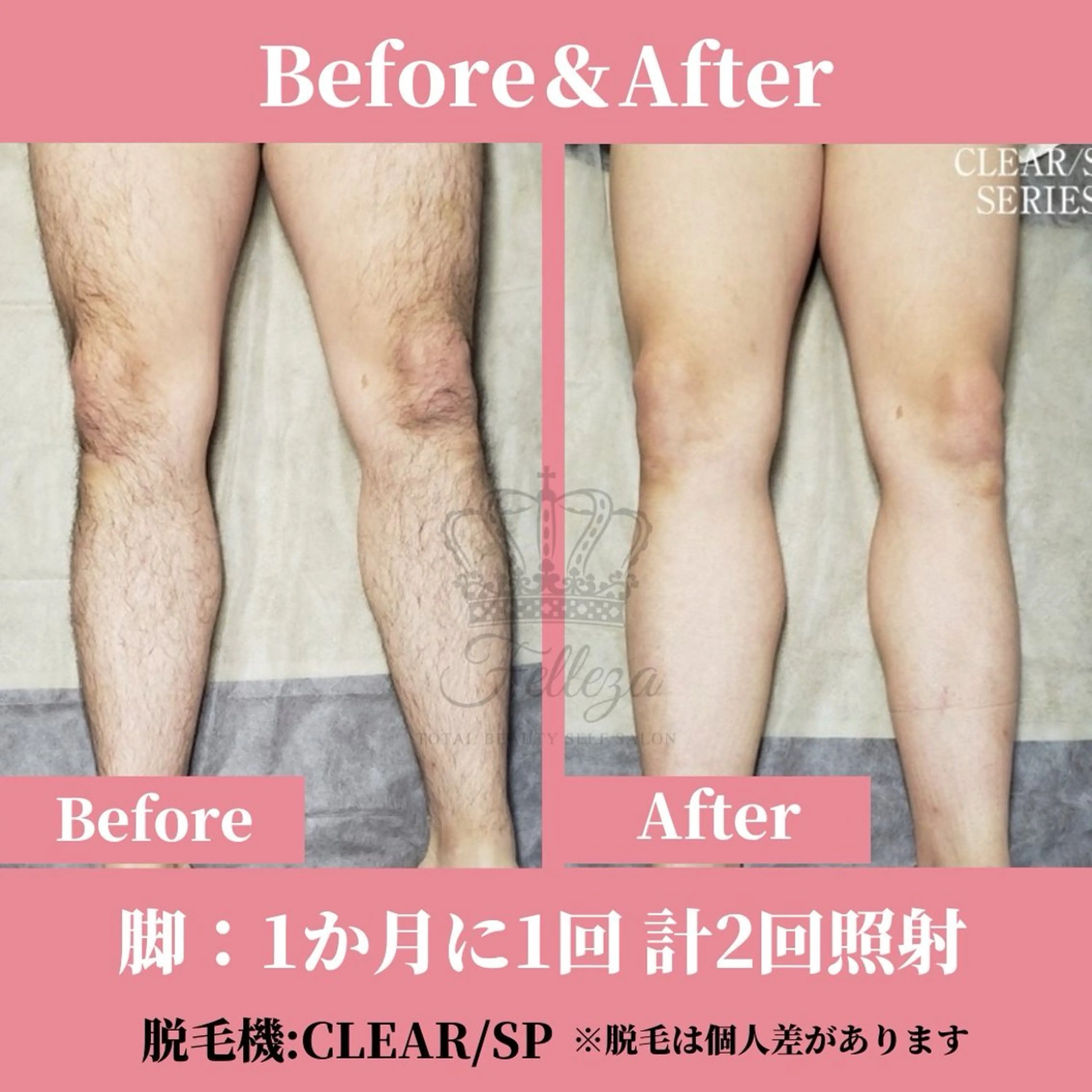 メンズ 有人型セルフサロン 脱毛／痩身／美顔のその他イメージ