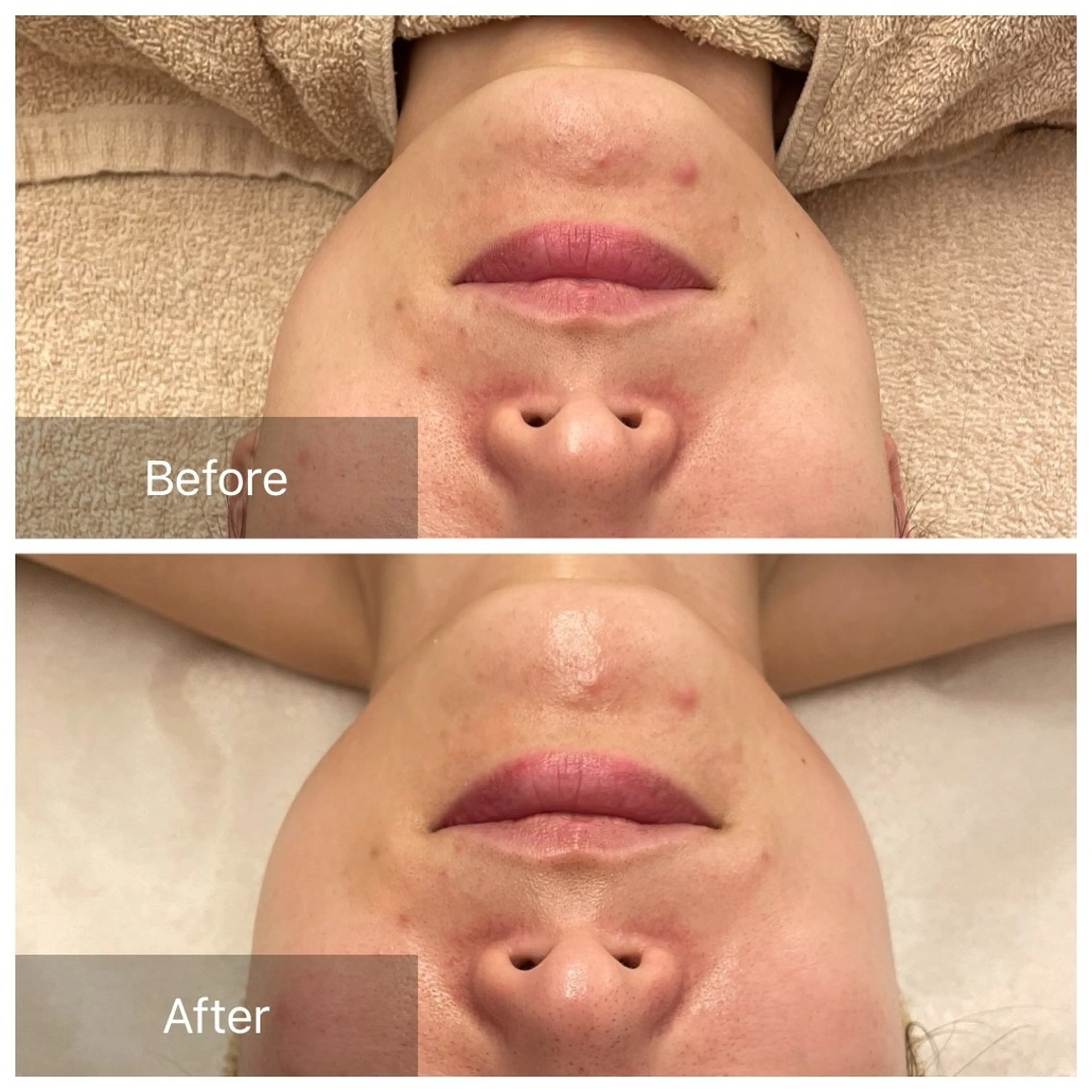 エステ ハーブピーリング 肌再生ピーリング/のエステ・リラクイメージ