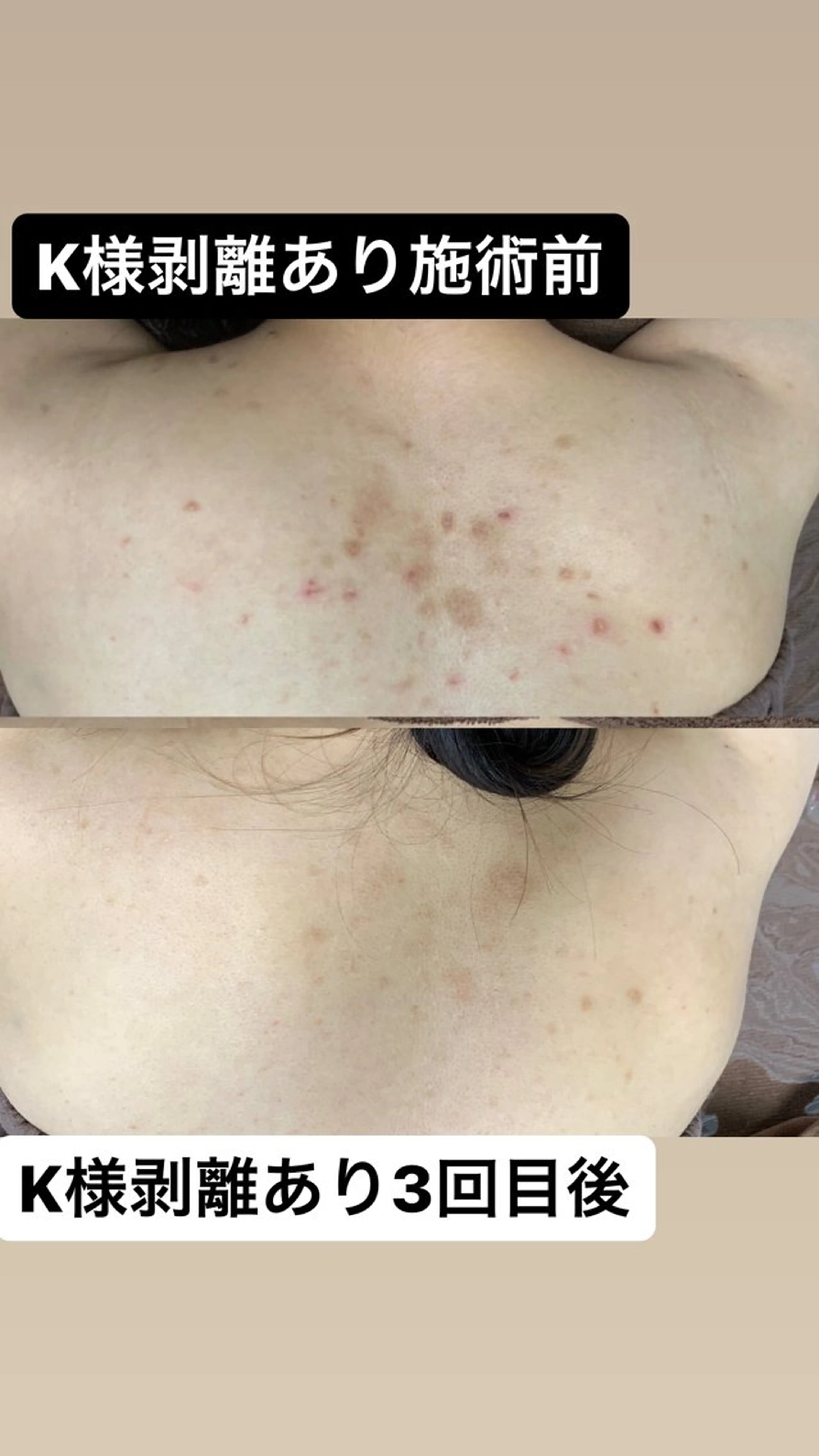 REVI陶肌背中ハープピーリング 11000円の写真