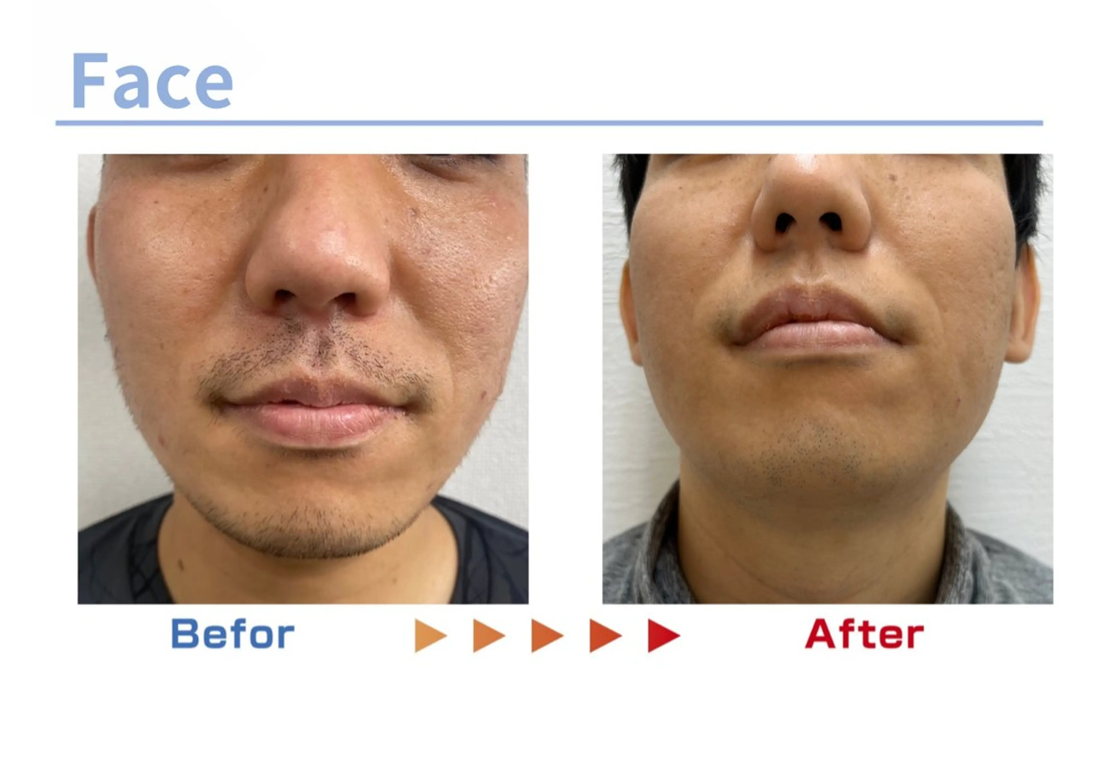 脱毛 セルフ脱毛/美尻イス キングスサロン熊本のエステ・リラクイメージ