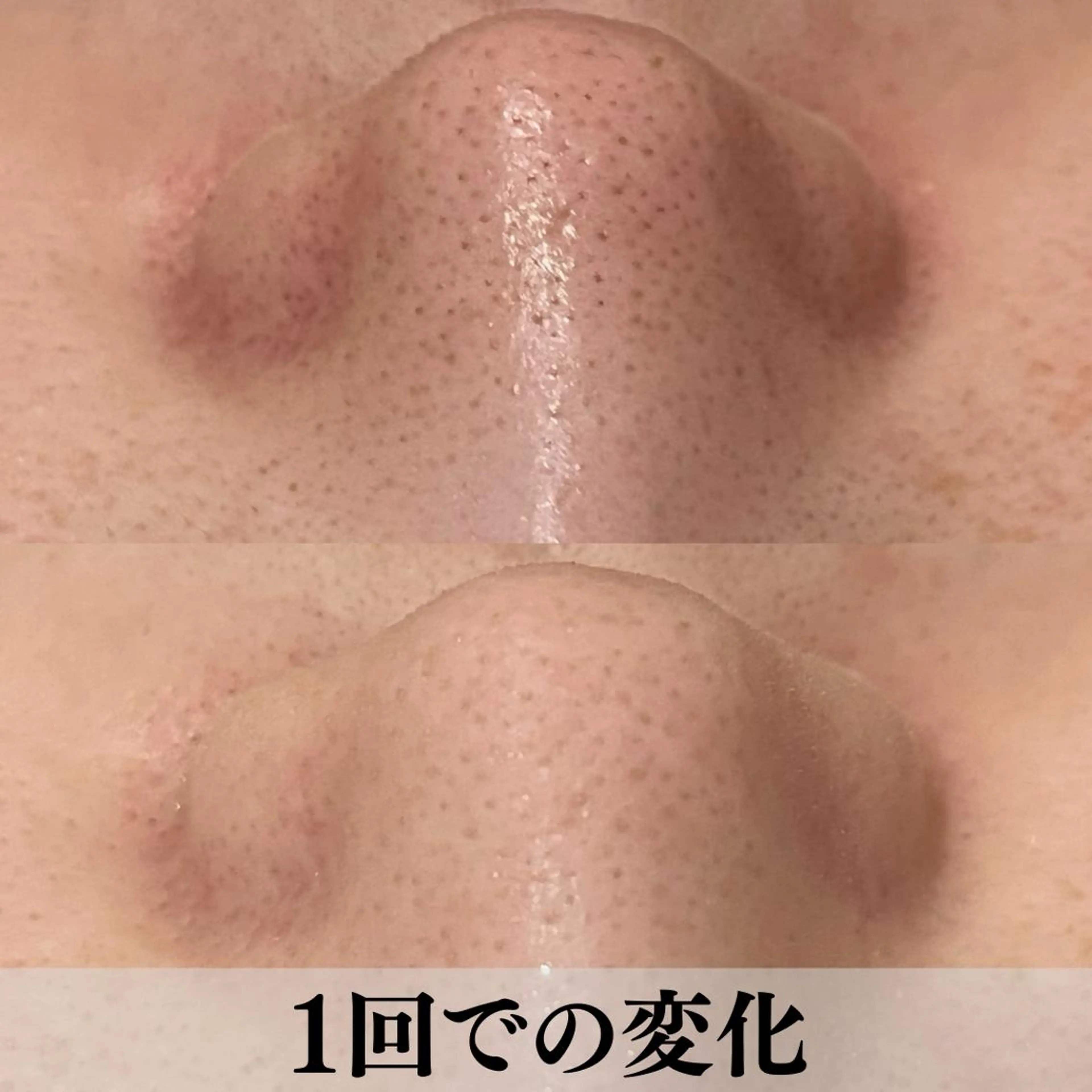 学生ニキビ改善🍀 優しい肌質改善のエステ・リラクイメージ