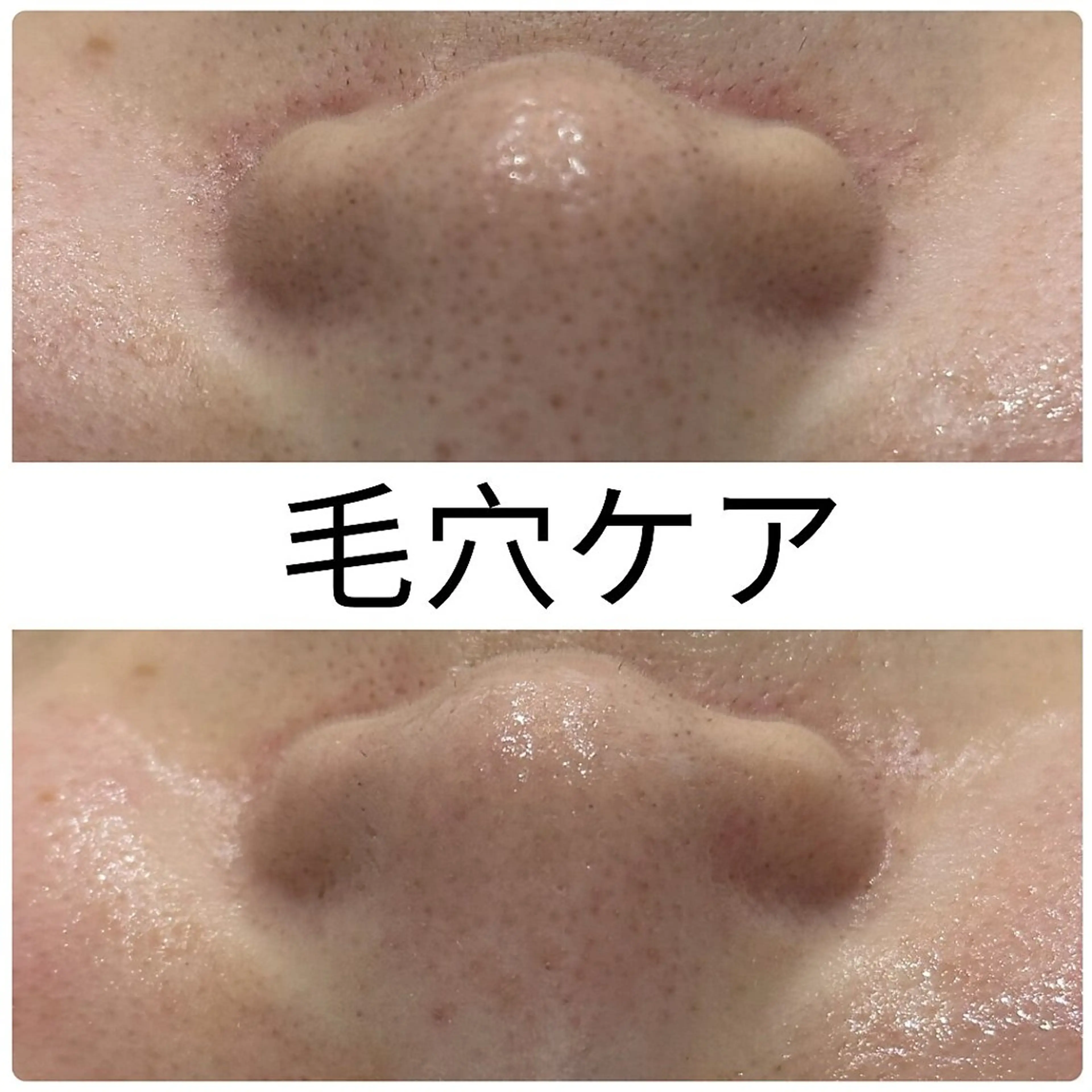 黒ずみ撃退【毛穴ケア】剥けないハーブピーリング¥15,400→9,900(生酵素入り)の写真