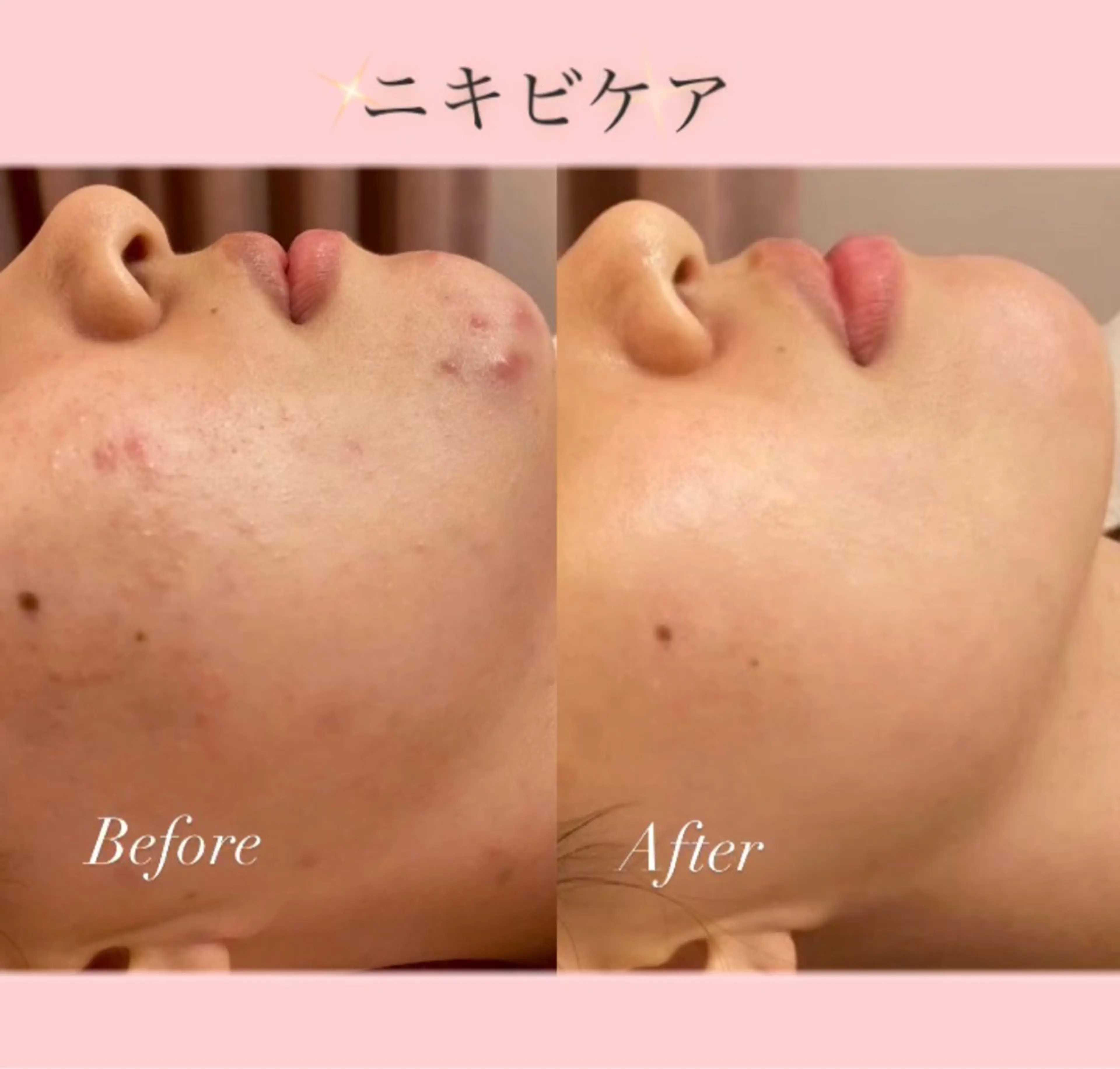 ✨🌿【3月限定】【韓国美肌/ニキビケア】肌質にアプローチ/ニキビケア専用💆🌿✨の写真