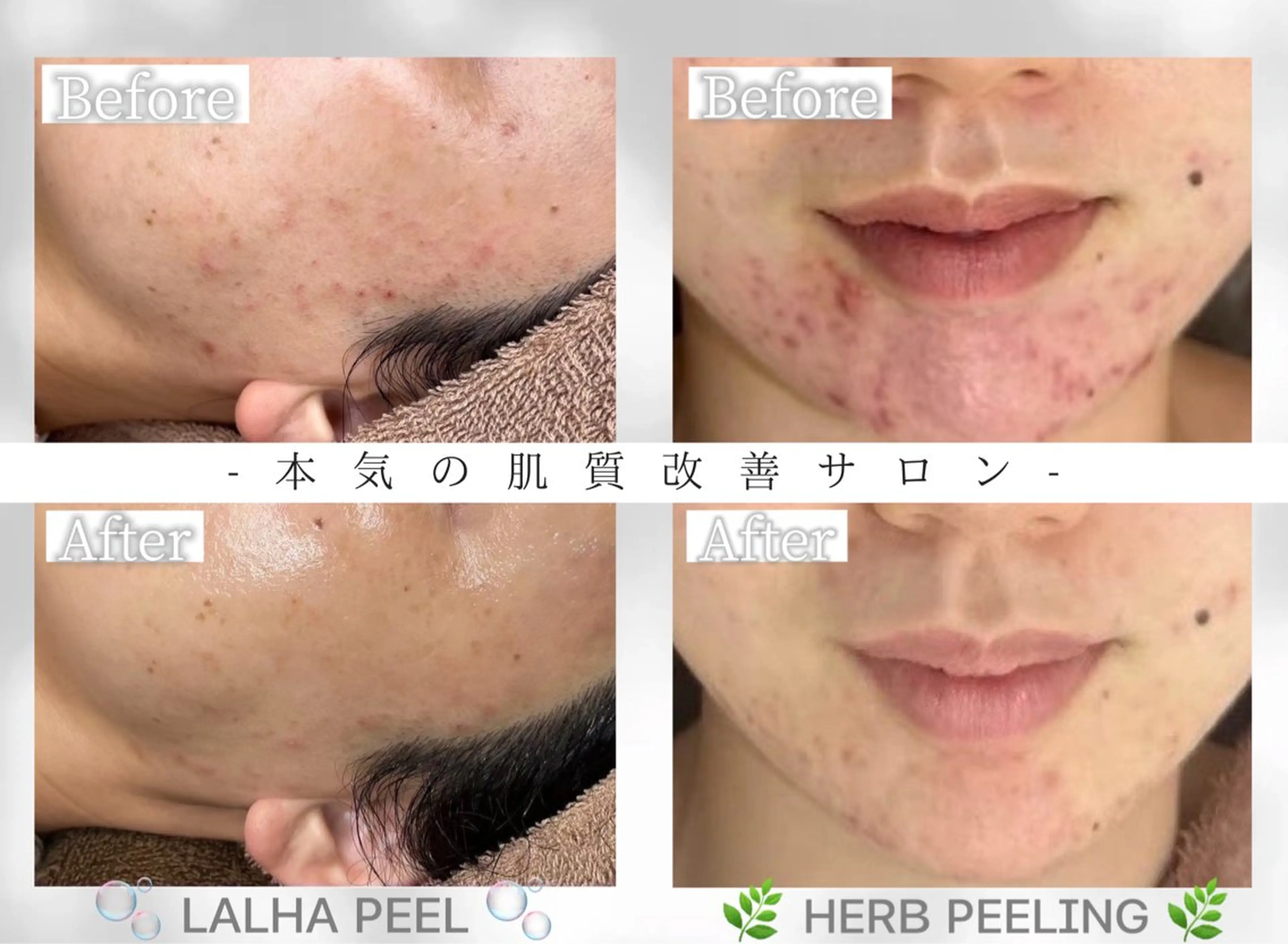 毛穴・ニキビケア　ハーブピーリング【肌管理専門店】WHITE AQUA鳳店所属・ホワイトアクア 鳳店のエステ・リラクイメージ