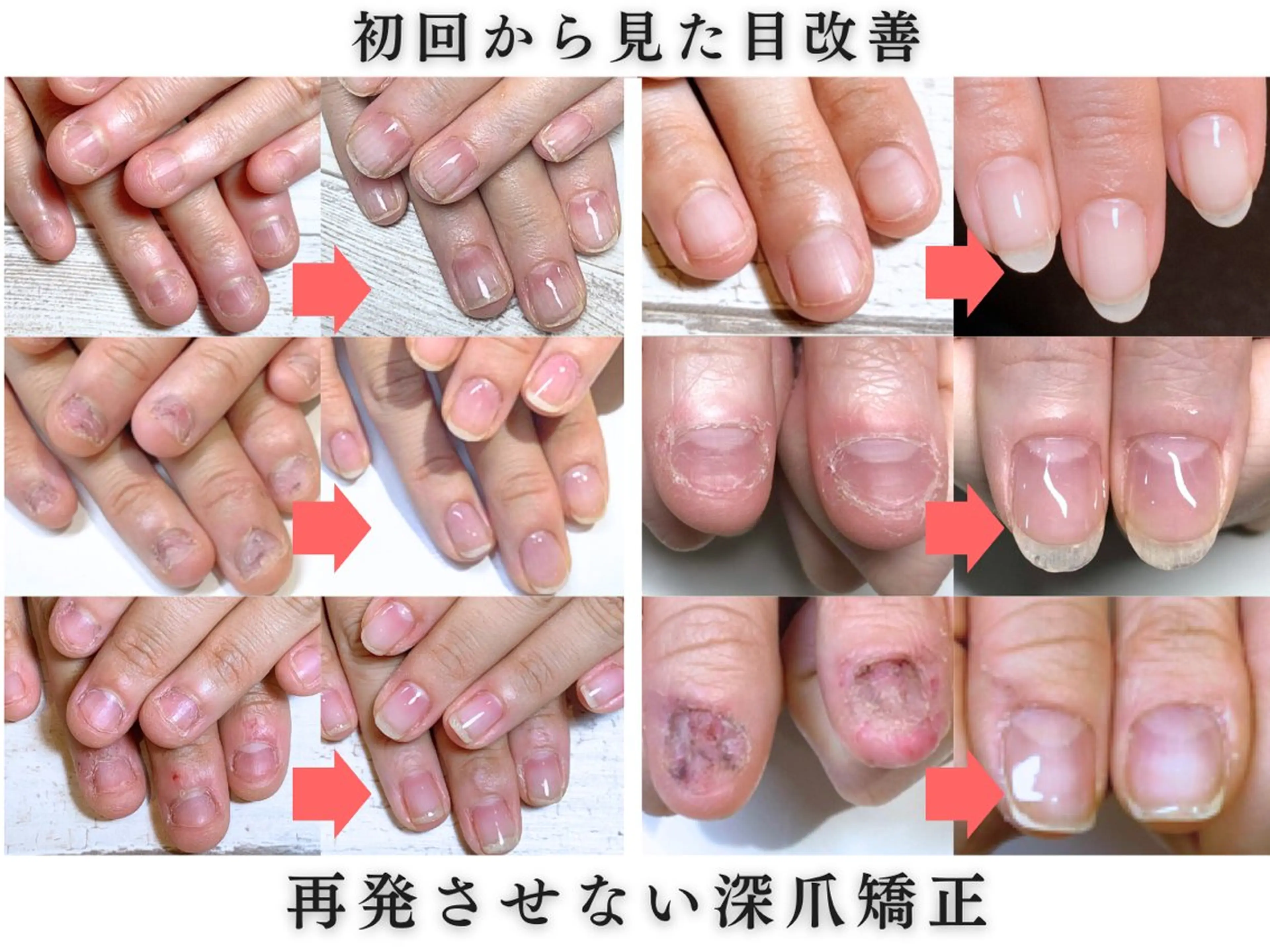 ネイル 深爪矯正・自爪育成 ネイルサロンアモここのネイルデザイン