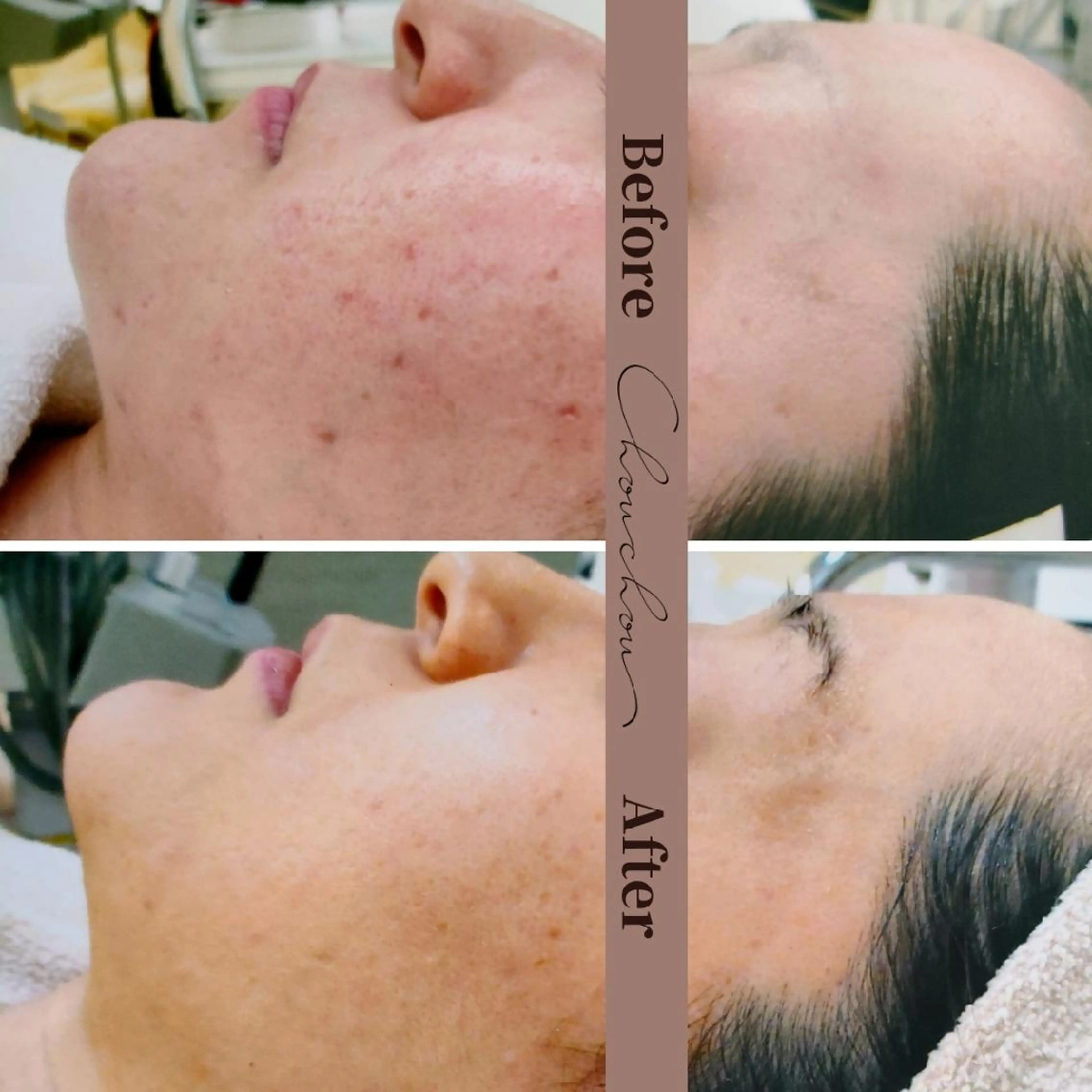 beauty & health salon Chou chou所属・ニキビ・毛穴🌿肌を 育てるララピール✨のエステ・リラクイメージ