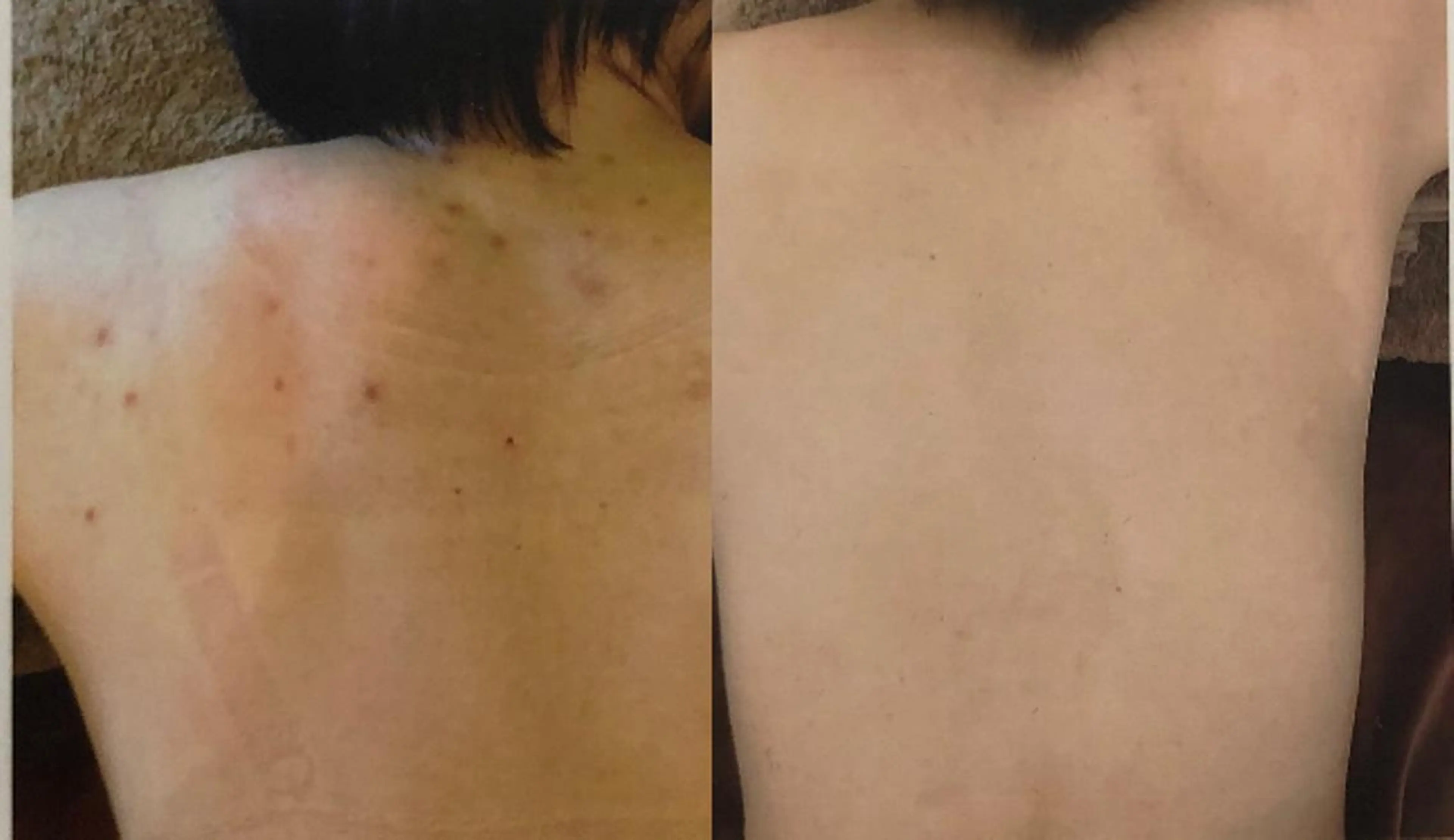 フェイシャルにきびケアーor背中にきびケアーの写真