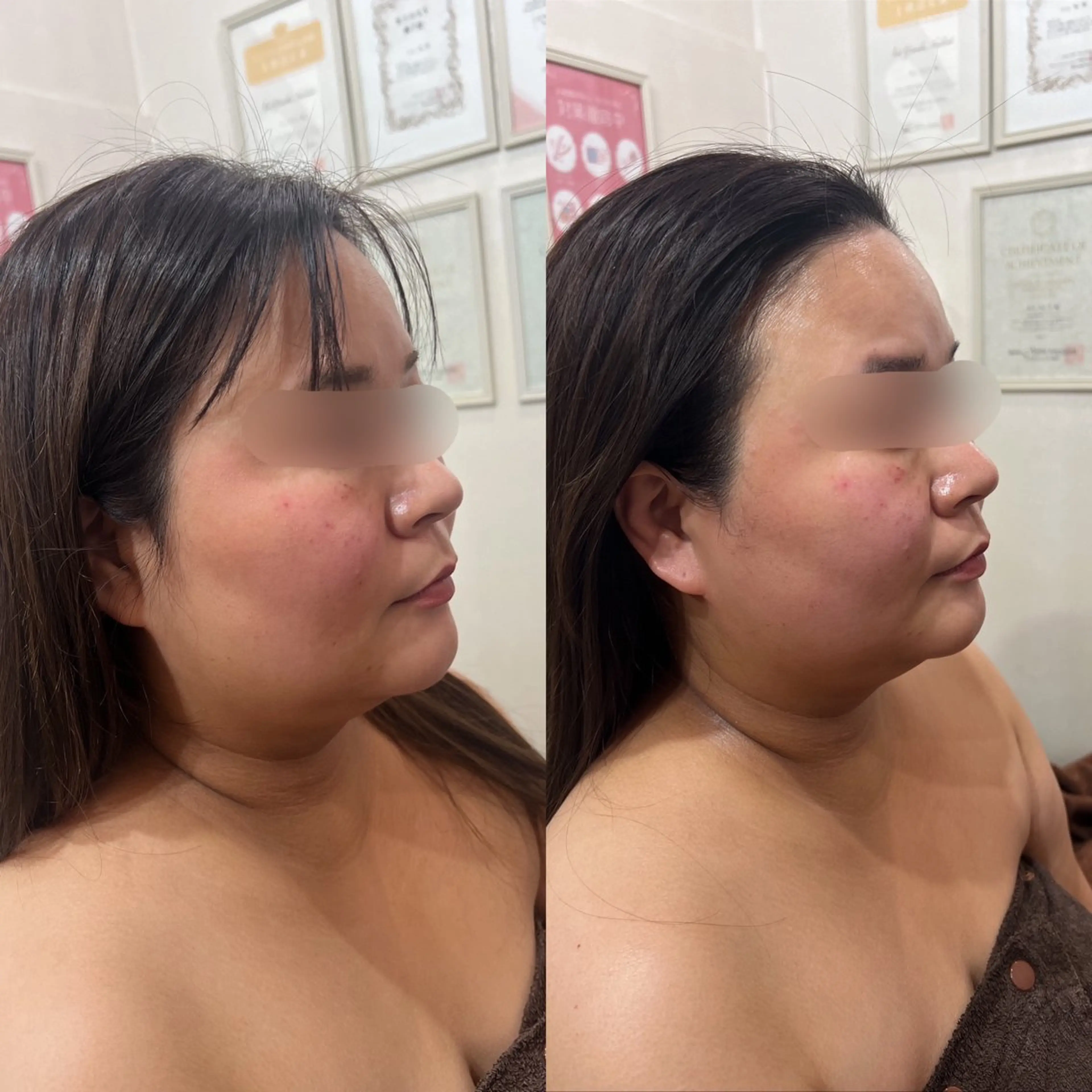 毛穴改善/脱毛 ネイル　川上久仁子のエステ・リラクイメージ