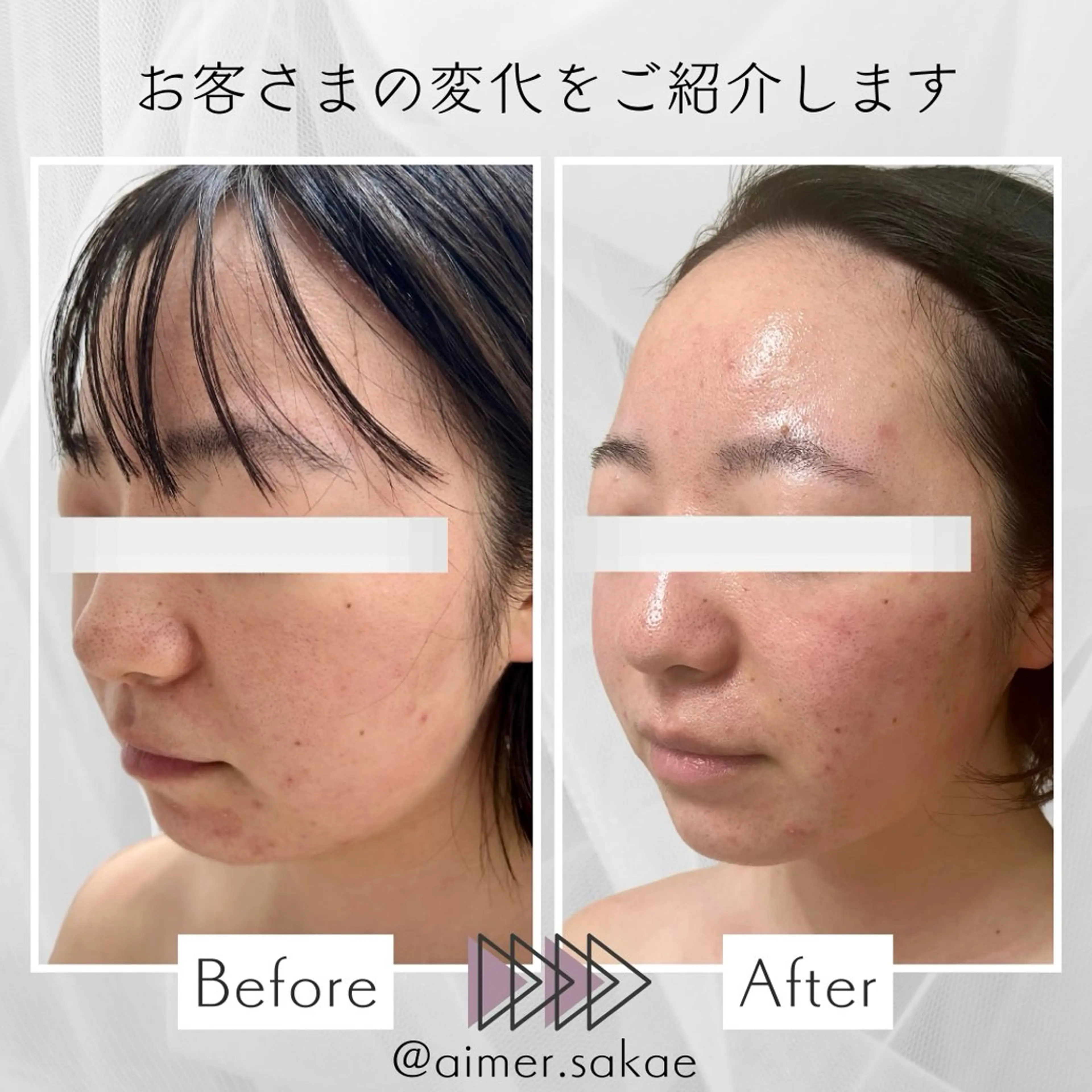 《学割》【小顔/二重あご/お顔の脂肪に◎】◆インモード×LDM水玉の写真