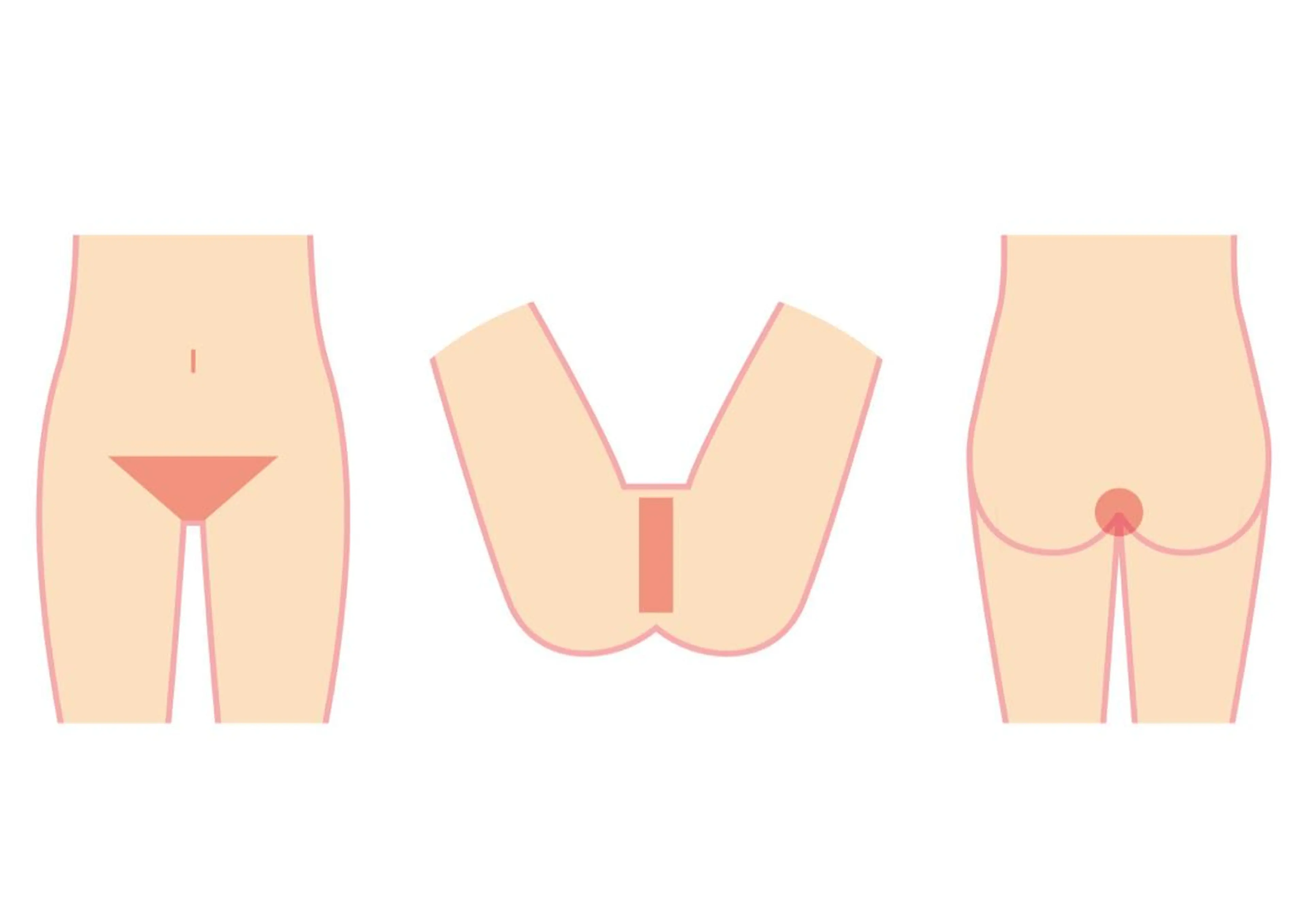 VIO脱毛 お試しも2回目以降も3000円‼︎ ※要事前シェービングの写真