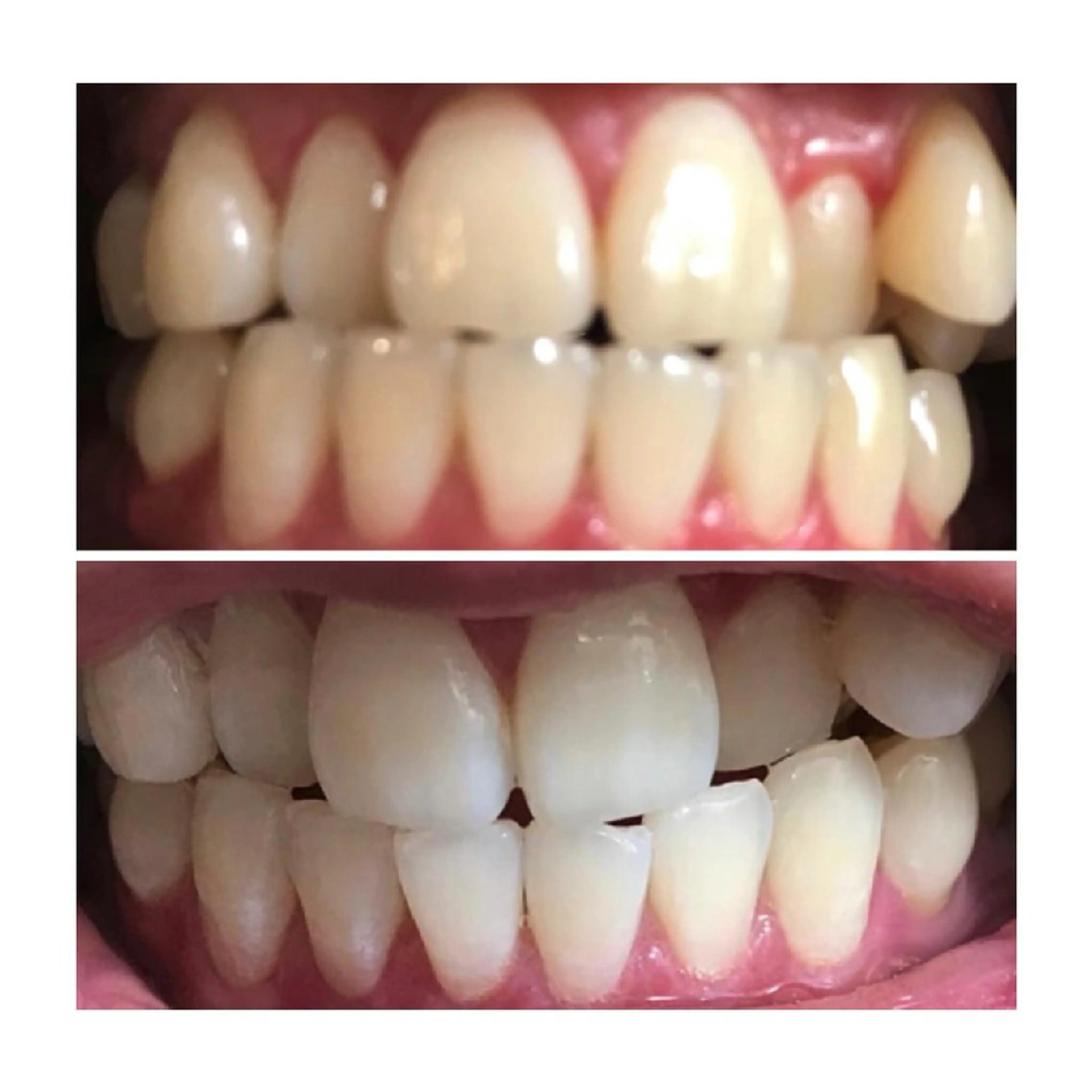 【minimo限定】ハイグレードホワイトニング🦷8分4回照射　結果が目に見える💯の写真