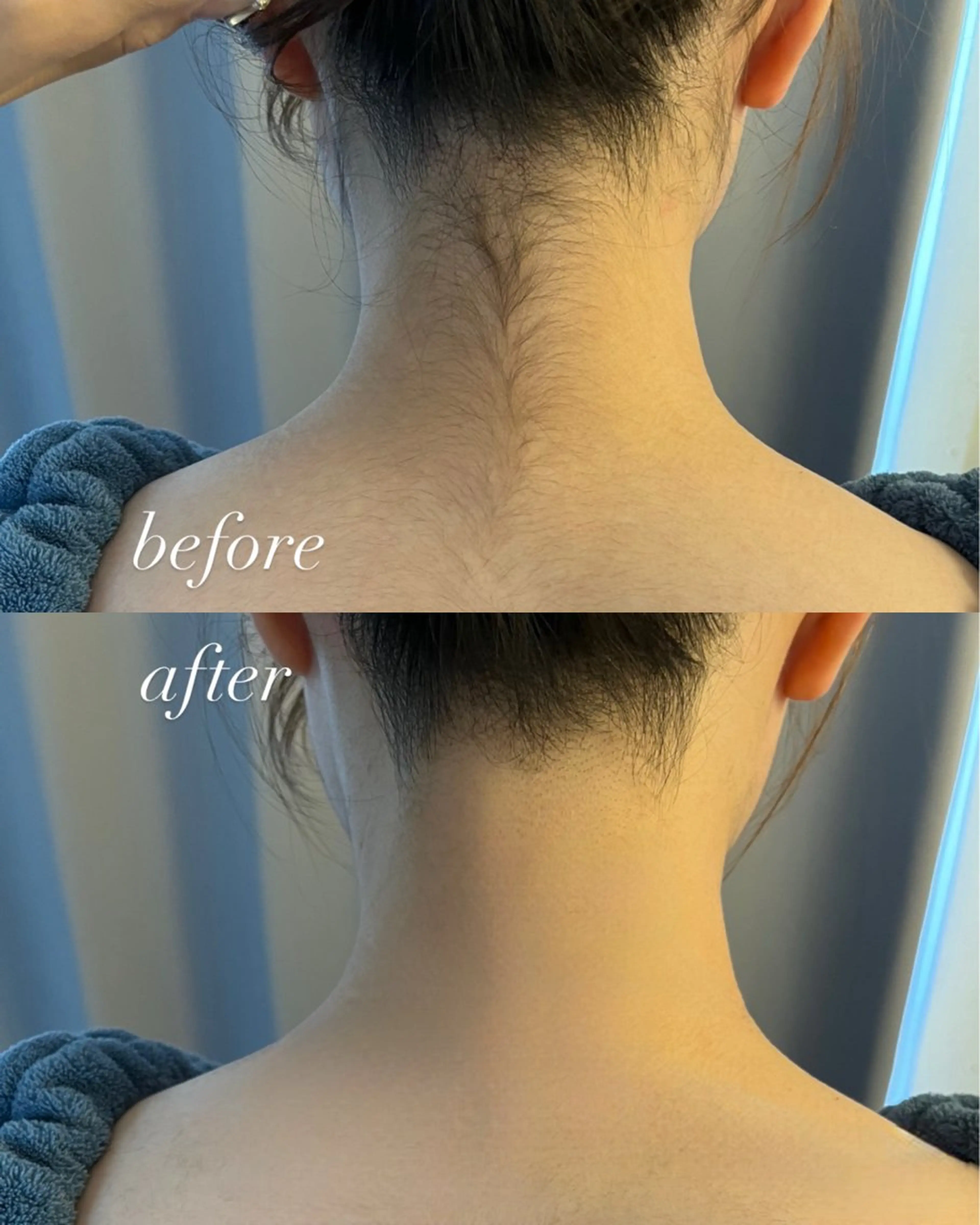 脱毛 うなじ脱毛/美肌脱毛 LABELのエステ・リラクイメージ