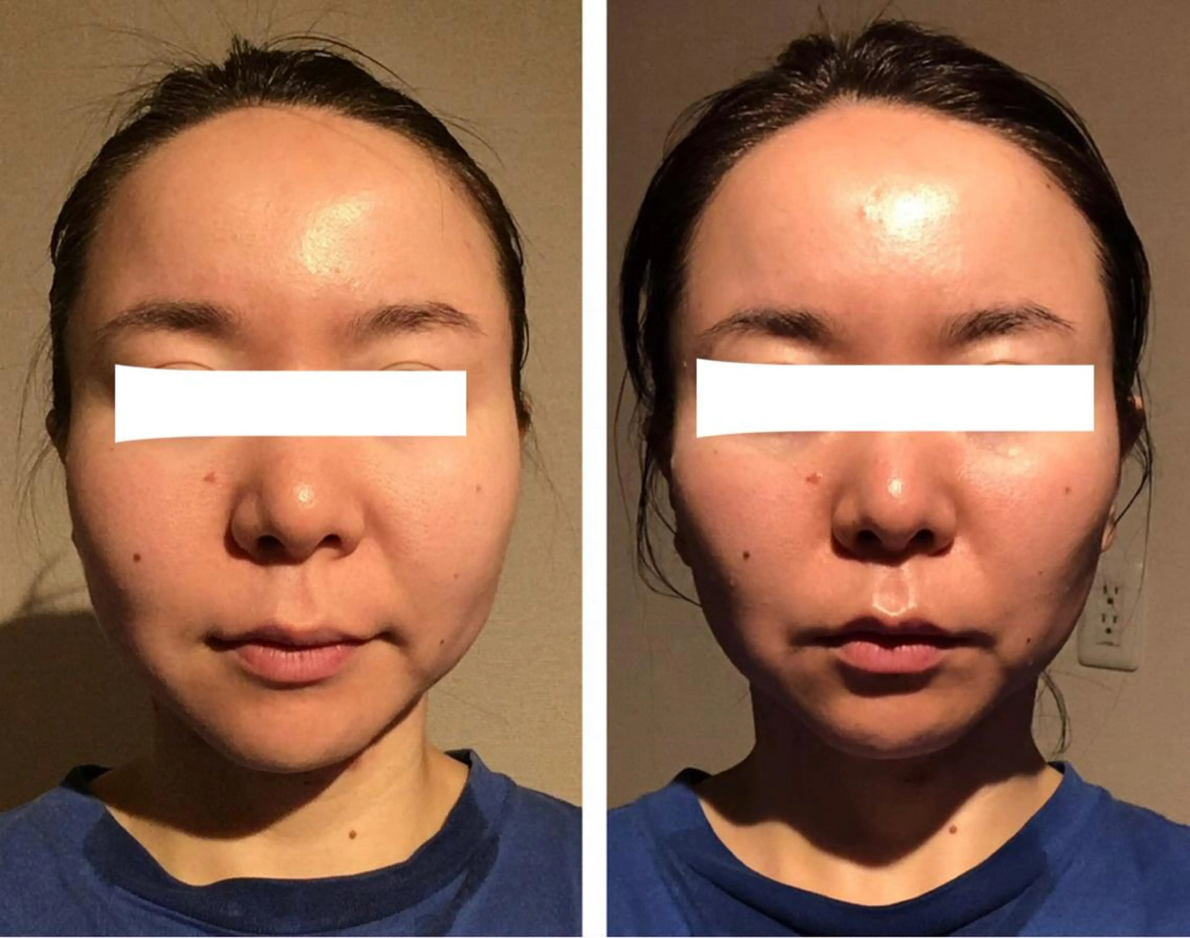 女性限定🌹小顔・フェイスライン 集中ケアの写真