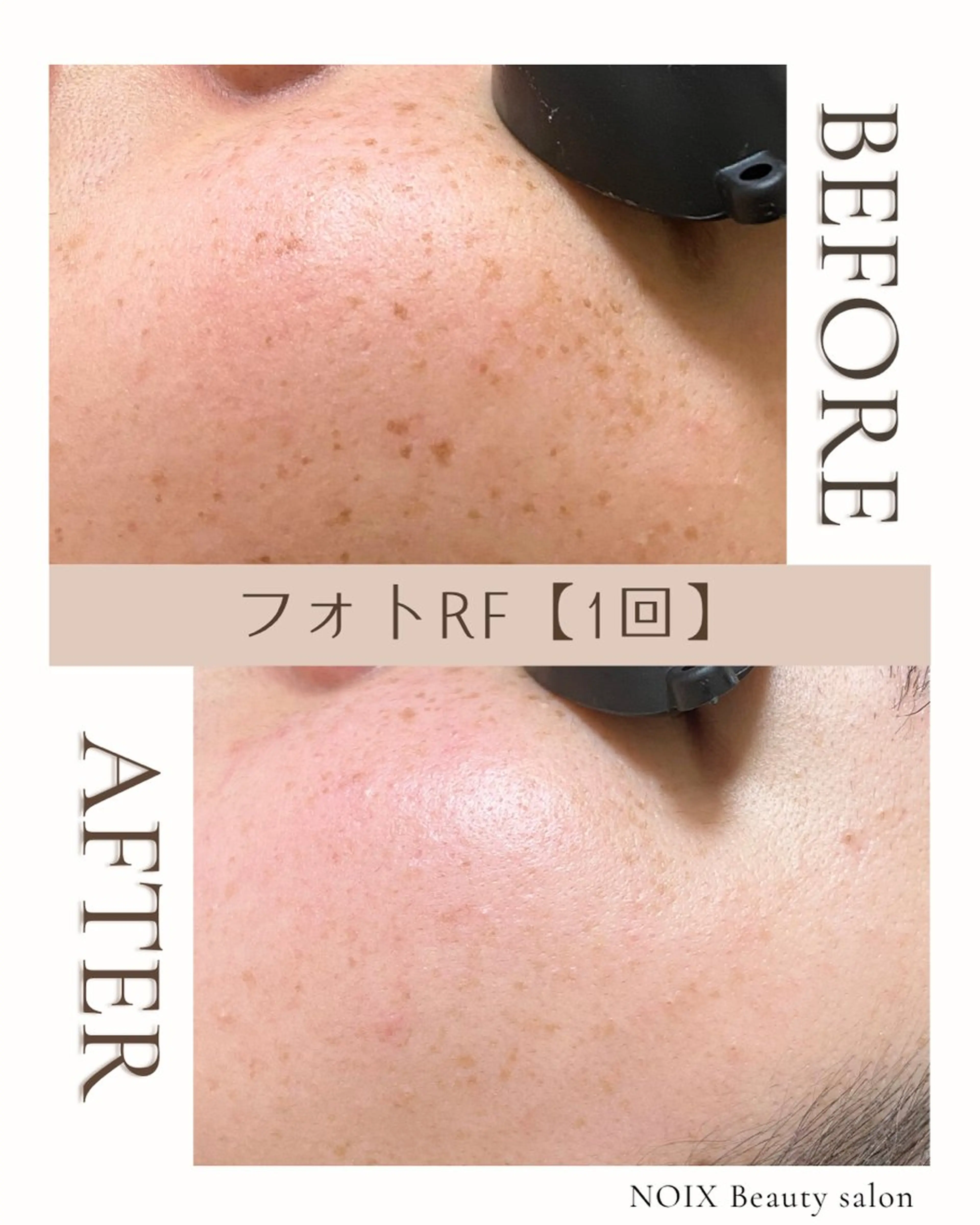 美顔フォトRF💎シミ・毛穴ニキビ跡ケア＋美肌パックで肌育×透明感✨の写真