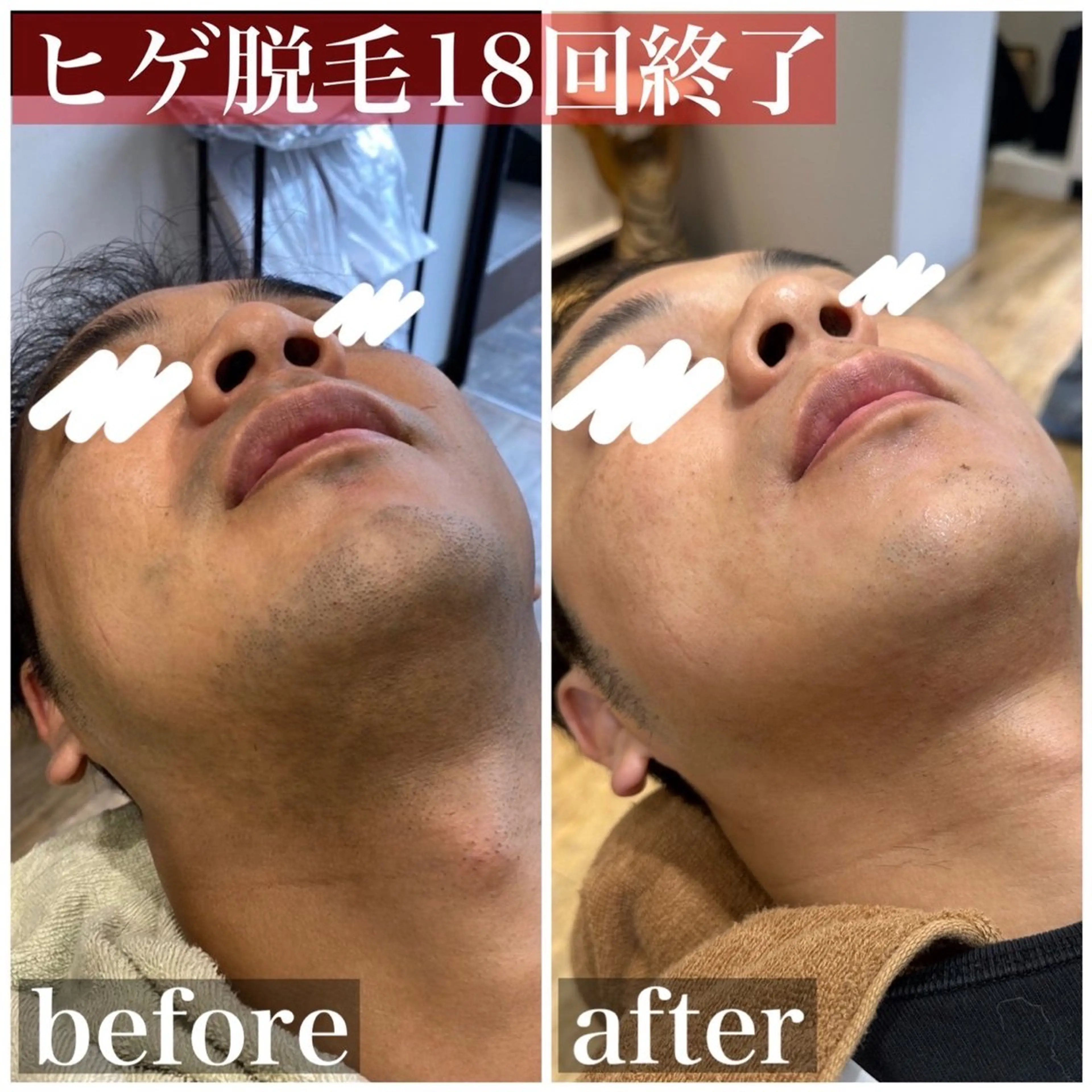 メンズ 脱毛 HAIRS YOSHIOKA所属・ヘアーズヨシオカ MENSヒゲ脱毛のエステ・リラクイメージ