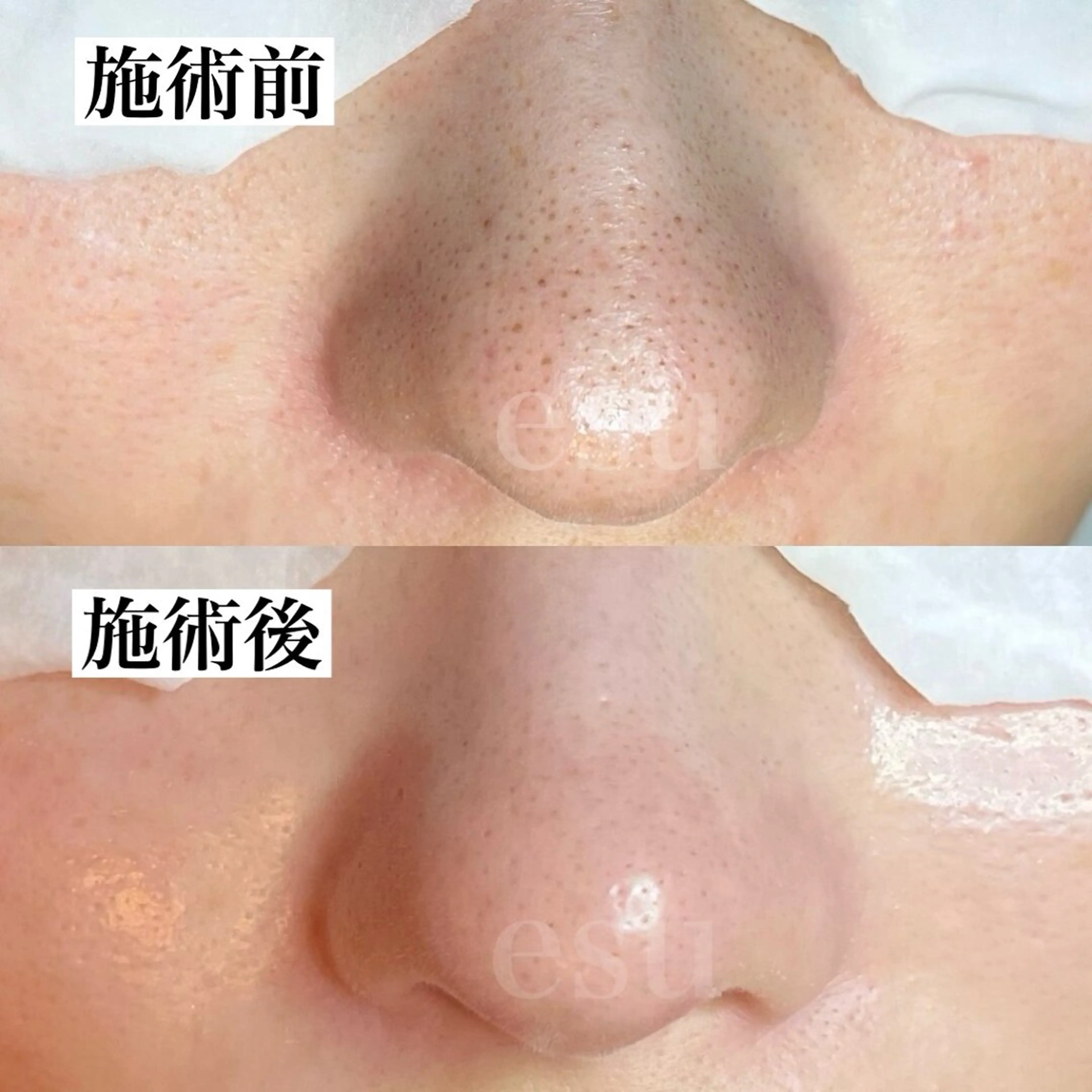 毛穴悩みallケア☆毛穴洗浄＋高保湿引き締めパックの写真