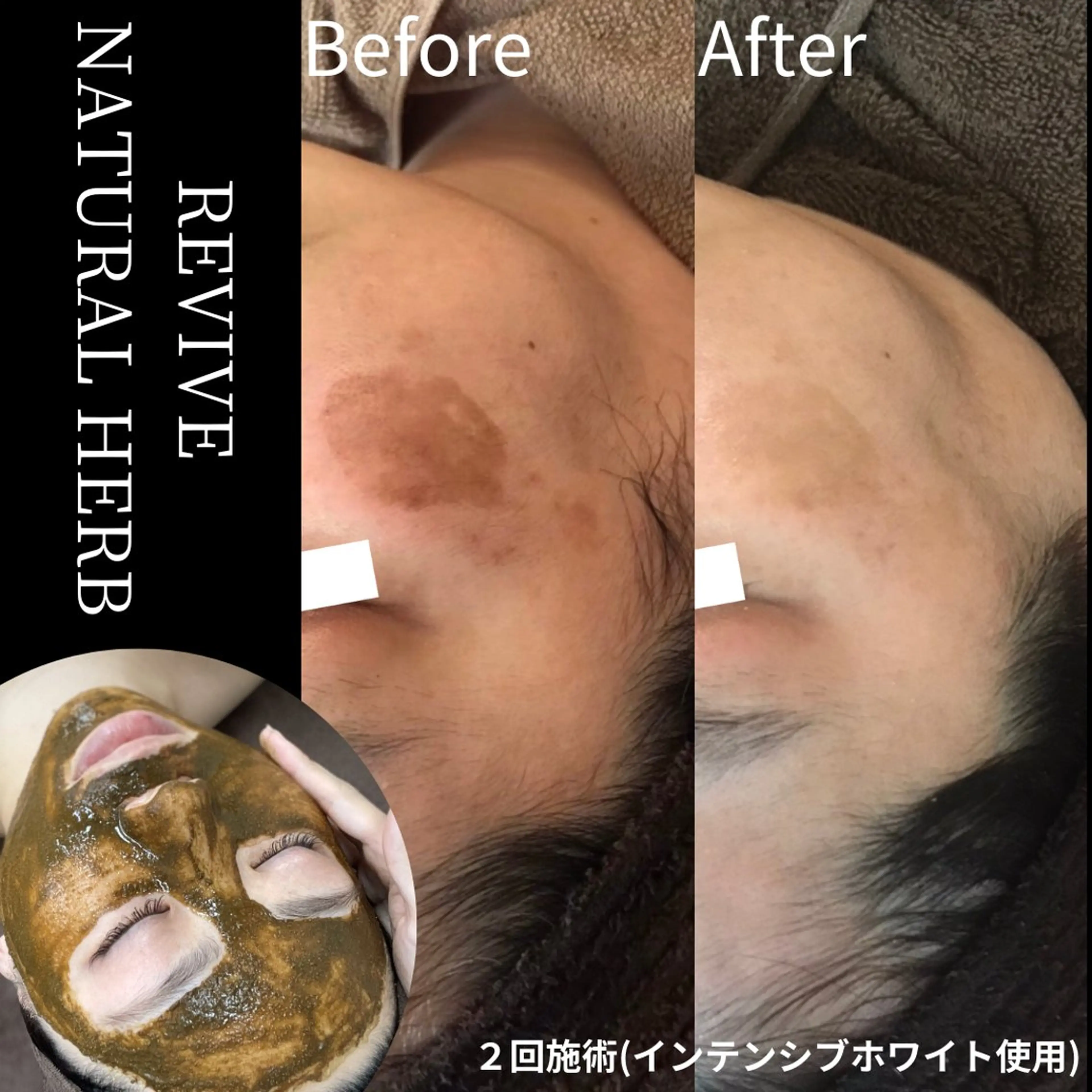 9月限定→肌質ケアハーブピーリングの写真