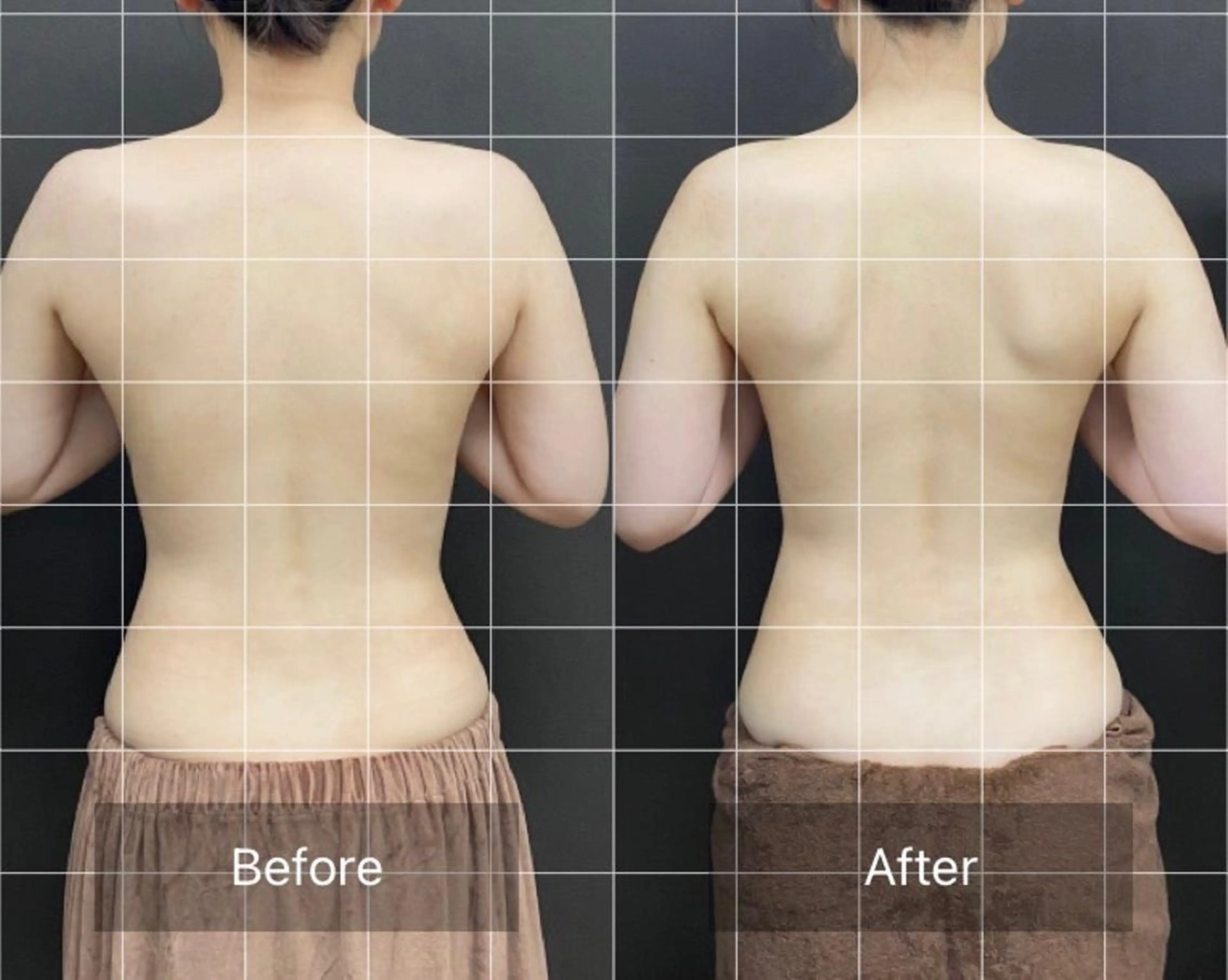 エステ ニキビ・毛穴改善 🌿ハーブピーリングのエステ・リラクイメージ