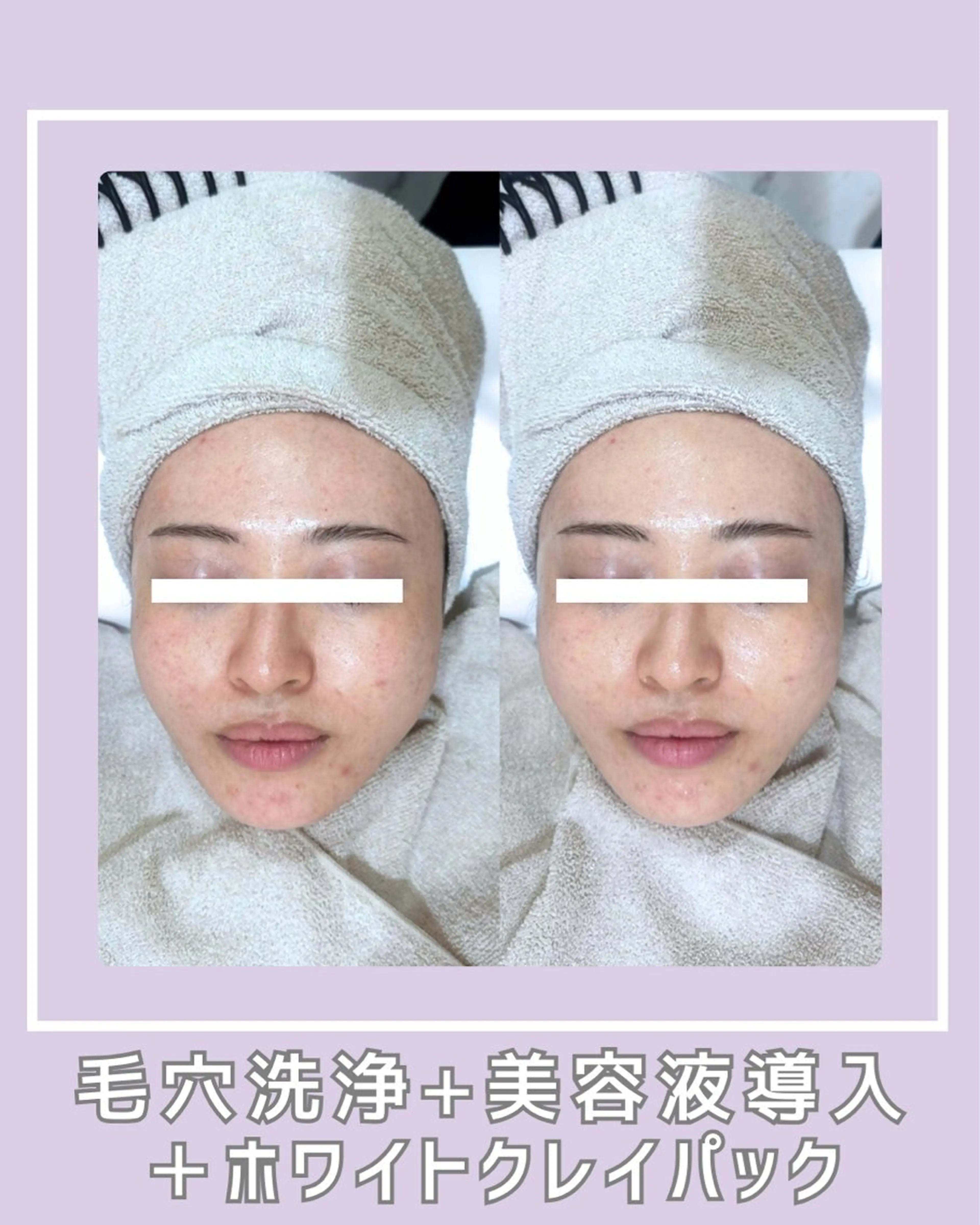 エステ |ピーリング・毛穴| soina神楽坂のエステ・リラクイメージ