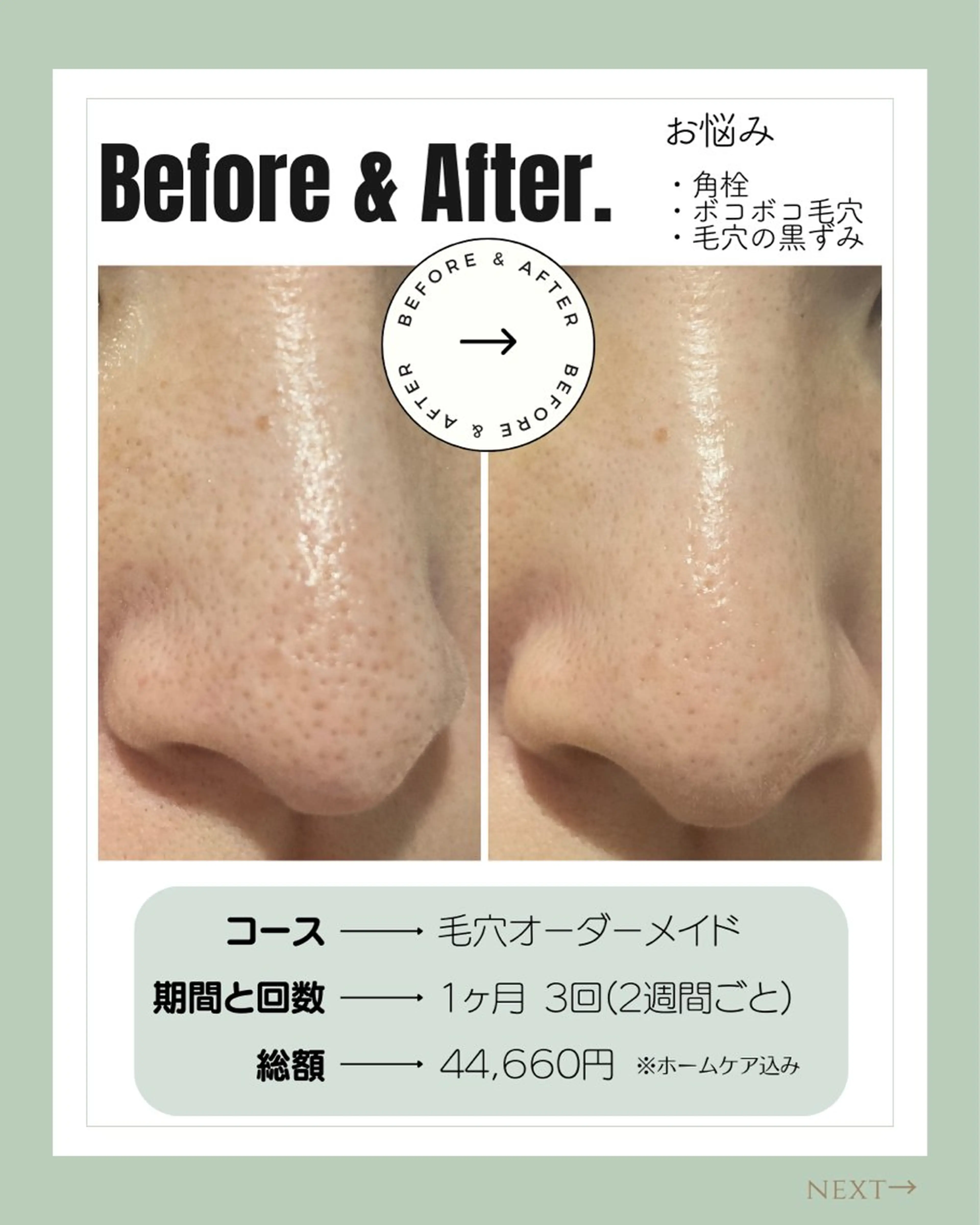 【肌質改善】ニードルピーリングコース(ニキビ、毛穴の開き、たるみの気になる方)メンズOKの写真