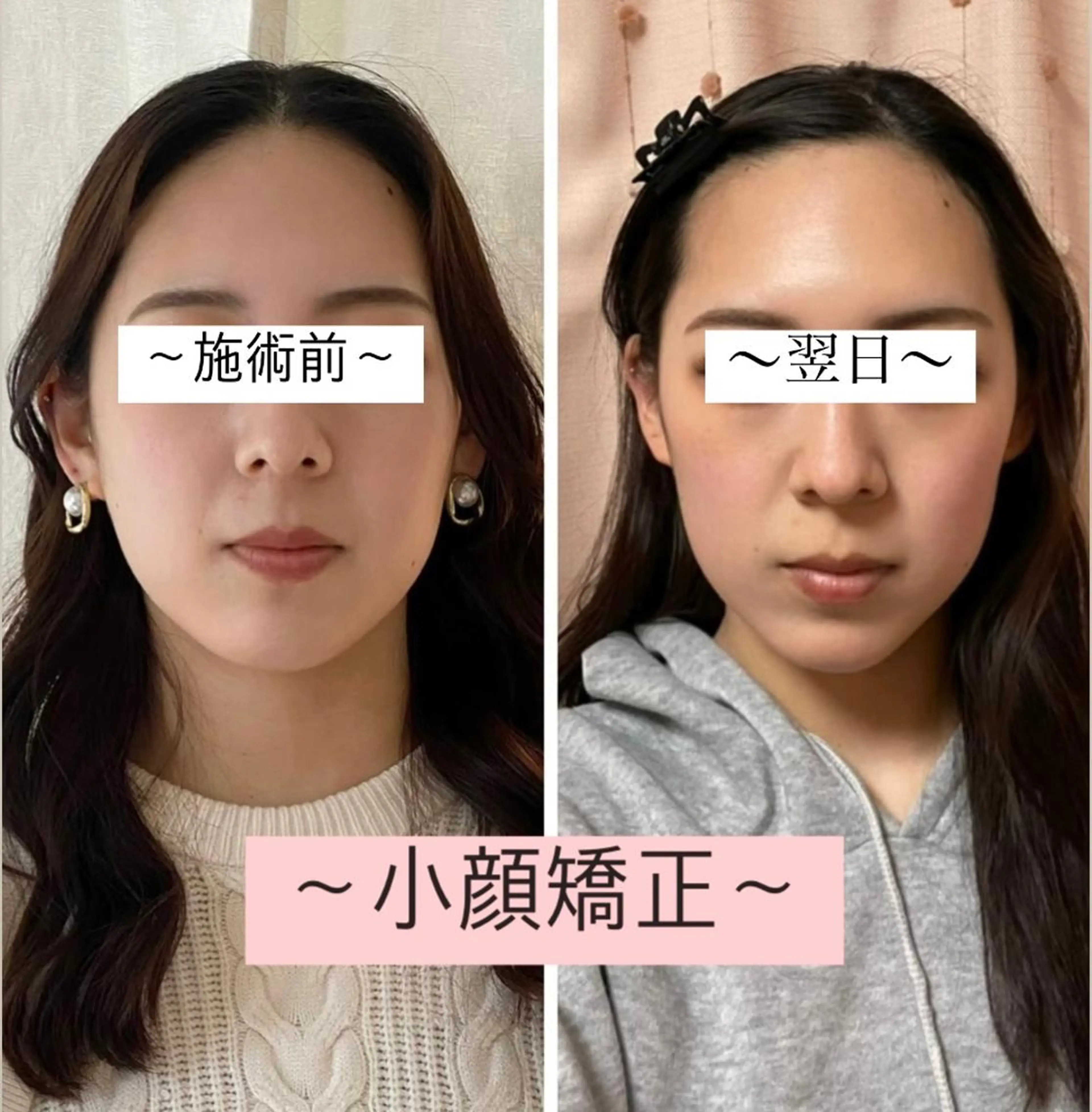 モニター様【圧倒的小顔美人へ】痛くない小顔矯正40分 小顔/エラ/歪み/むくみ/たるみ改善💎 ¥9500→¥6000の写真