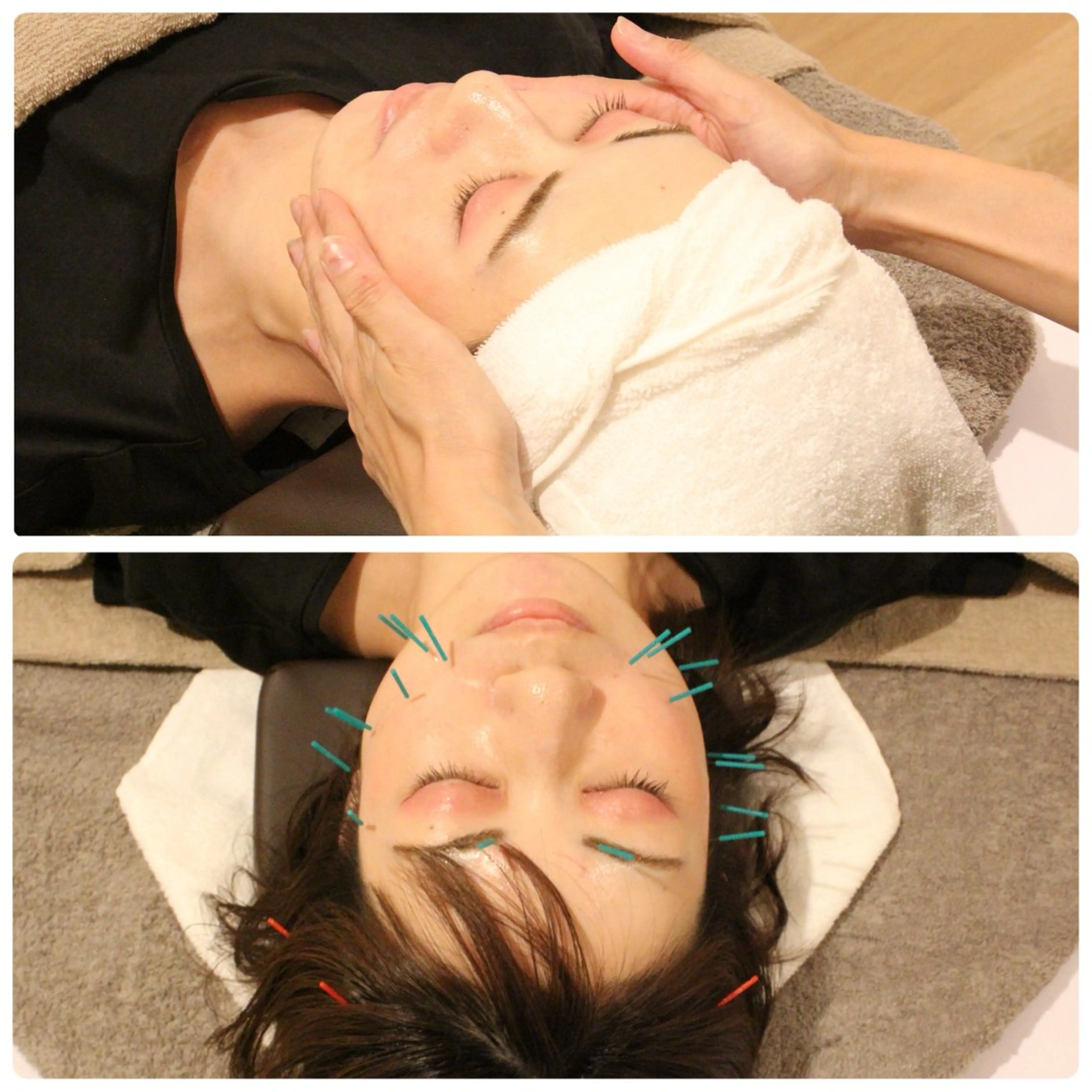 【美白/フェイスライン⤴️】小顔フェイシャル➕美容鍼➕ドライヘッドスパ　90分の写真