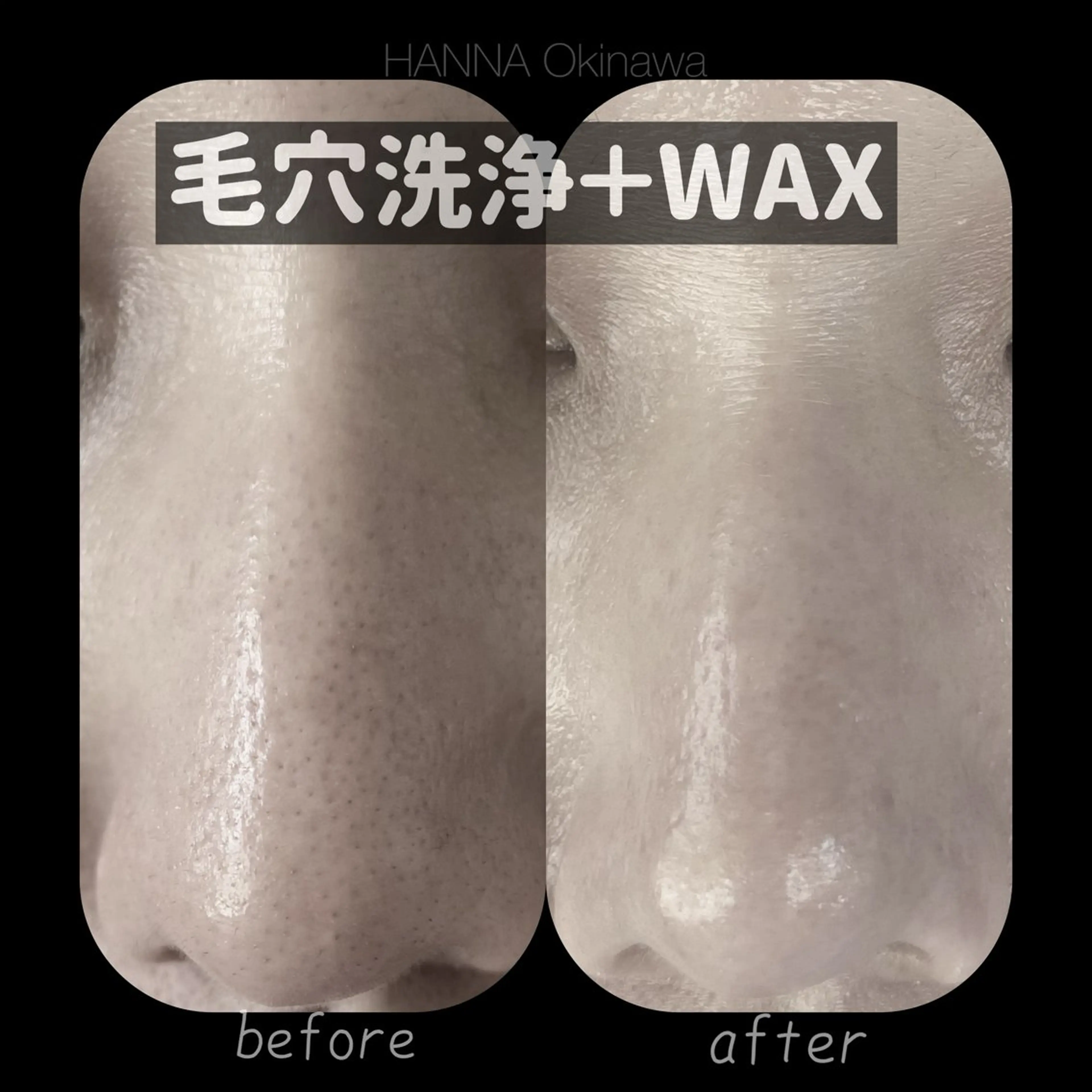 【毛穴洗浄＋鼻wax】美容液で角栓を取り除き、Wax脱毛によってさらに産毛除去♡つるつる度最強！の写真