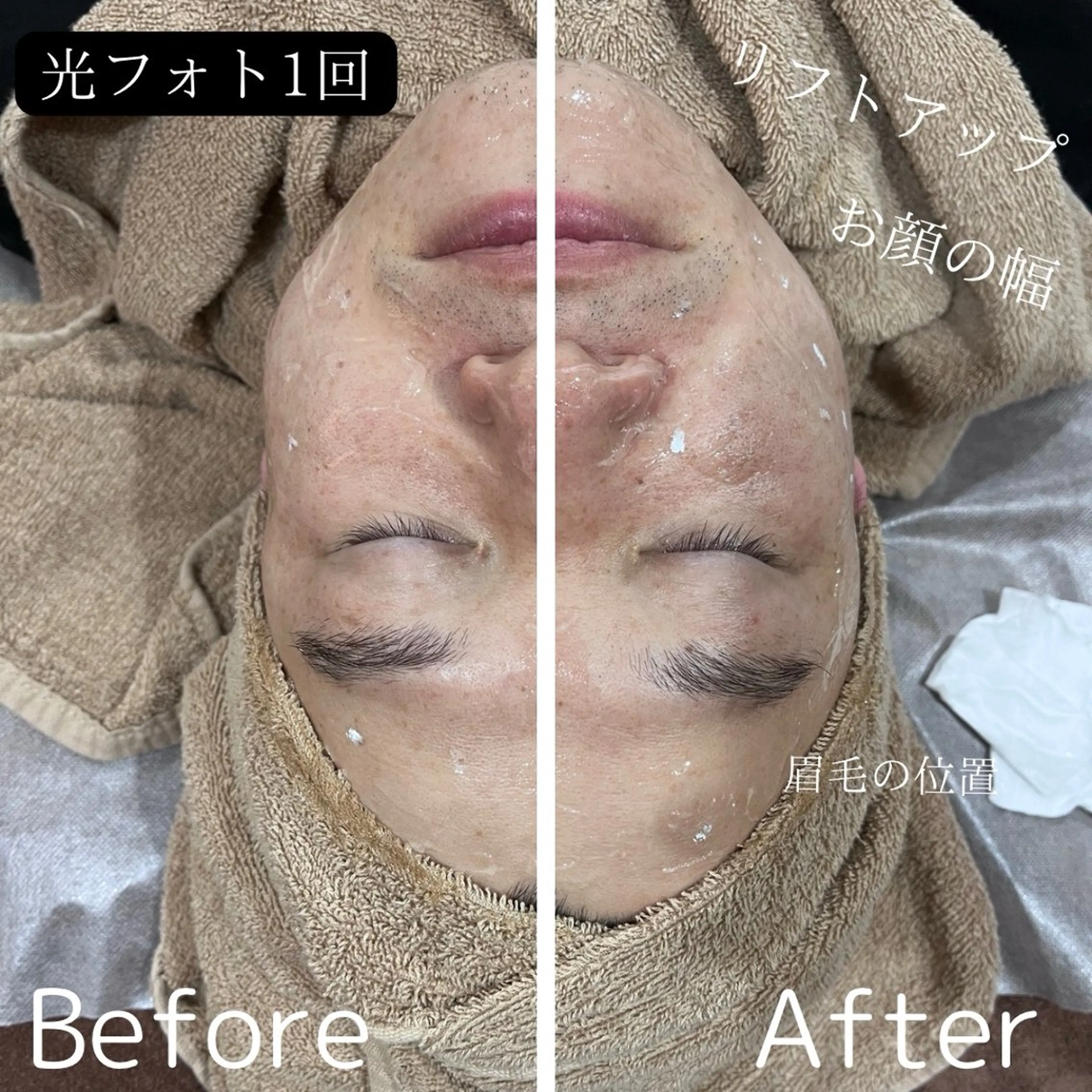 【むくみ解消/ニキビ/ニキビ跡/美白ケア】光フォト✨お悩み解消！の写真