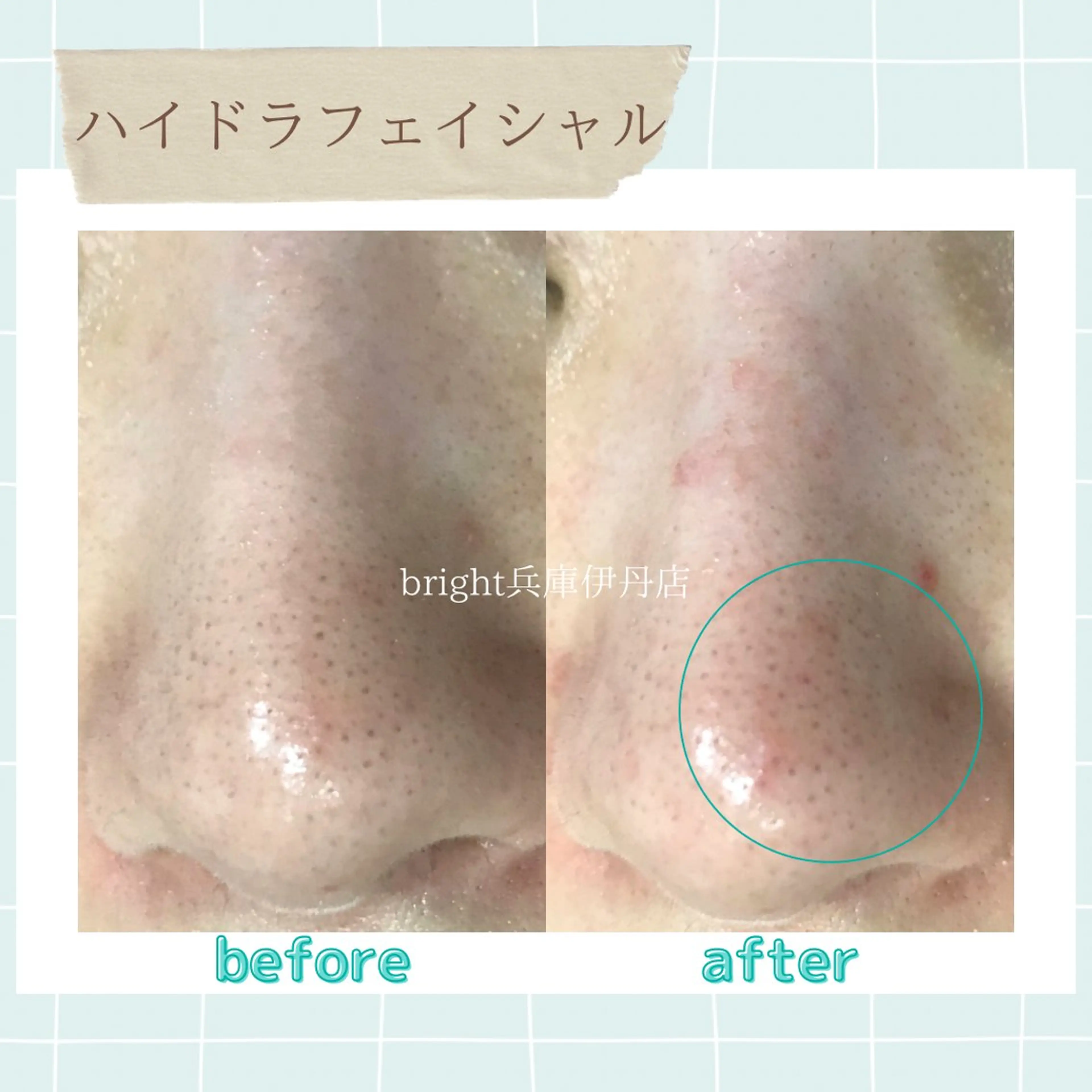 《スキンケアの最先端》毛穴洗浄💆‍♀️✨毛穴の黒ずみをスッキリ落とす👃初回体験¥3500✨の写真