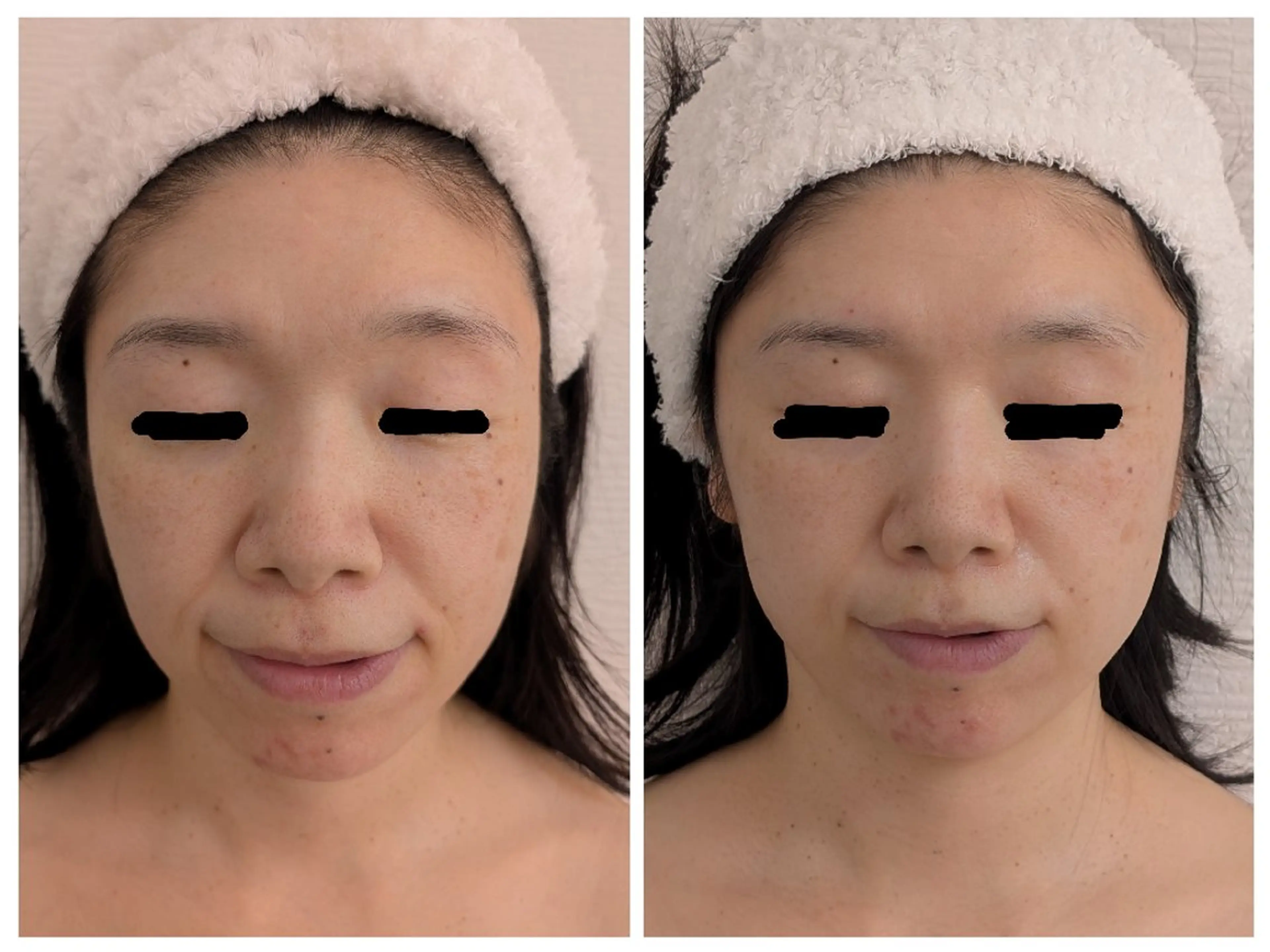 エステ レチノール/ニキビ/ 毛穴ケア　浅川のエステ・リラクイメージ