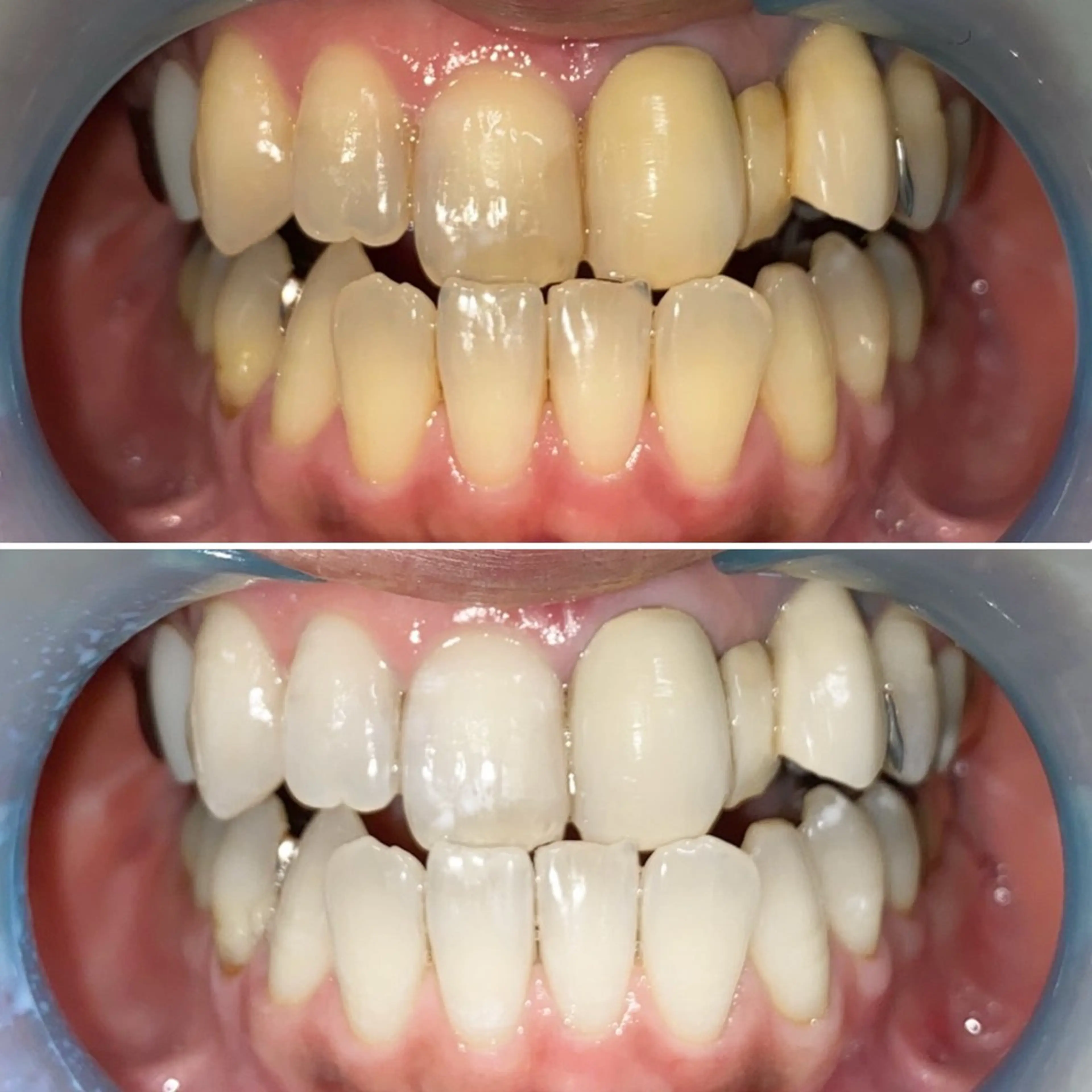 スタンダードホワイトニング 30分照射 メンズもOKの写真