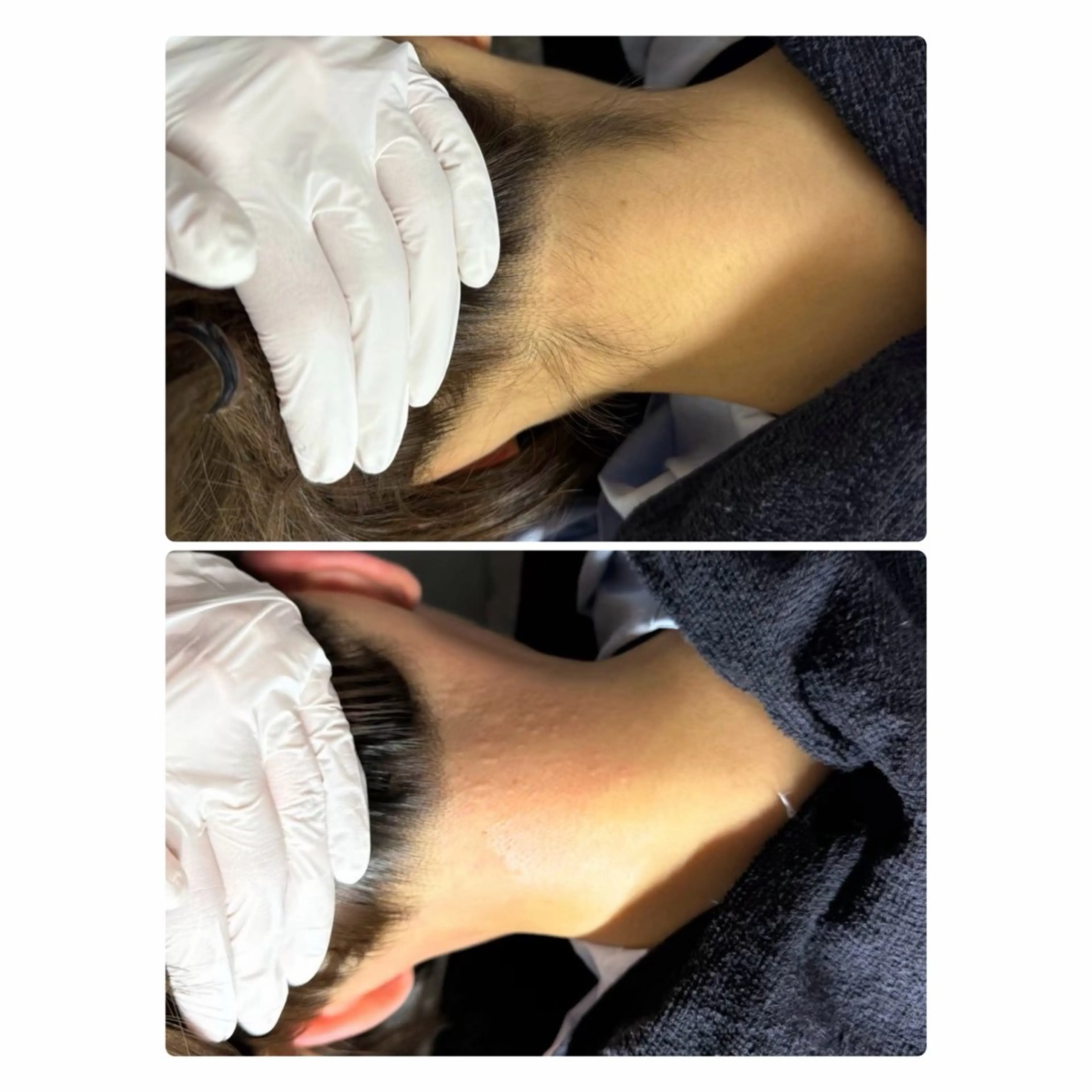 うなじワックス脱毛の写真