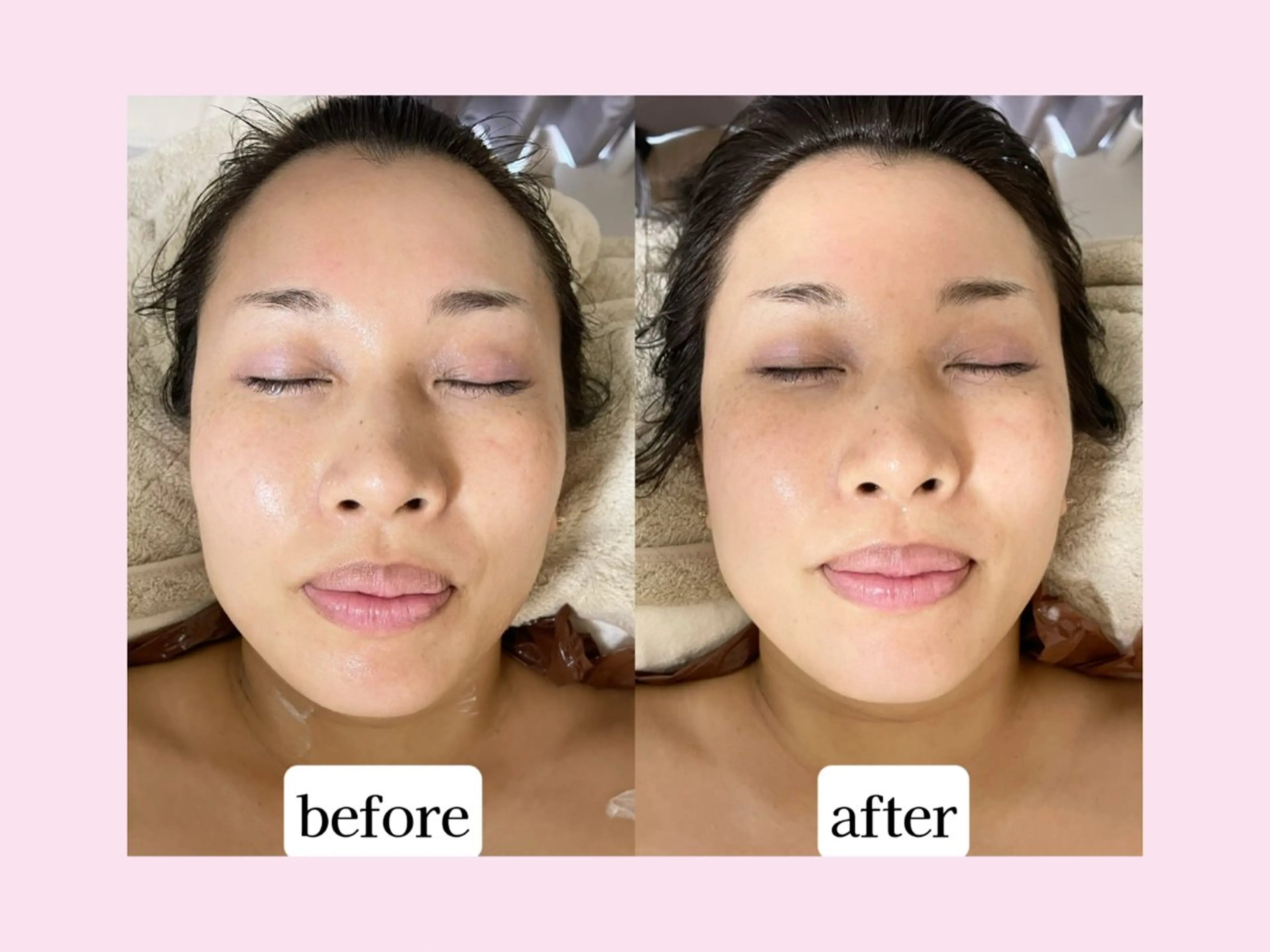 たった1回でフェイスラインスッキリ😍小顔フェイシャル💆‍♀️✨【夏限定🏖️】毛穴スッキリ炭酸パック付⭐️¥7700の写真