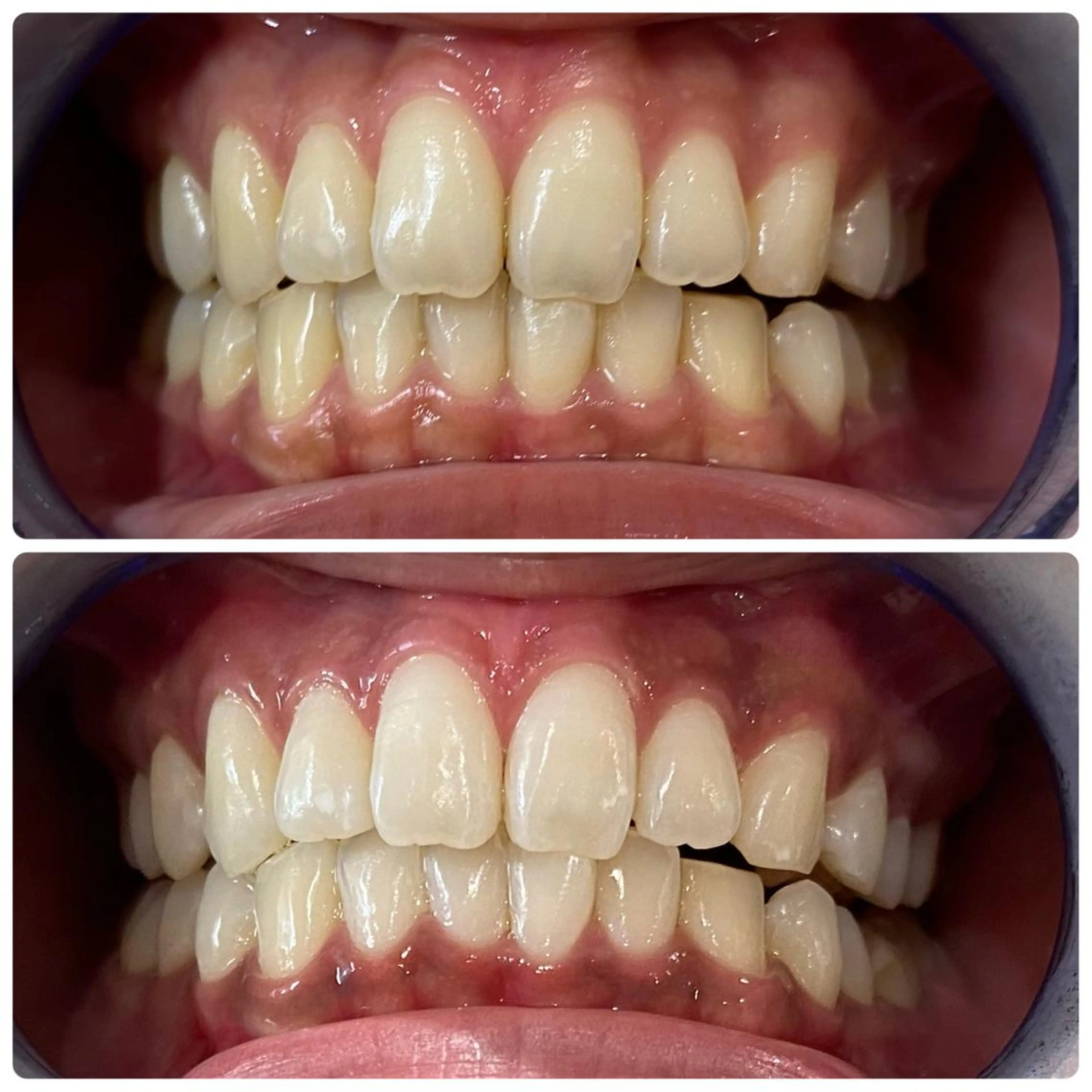 その他 White Berry SELF BEAUTY SALON所属・セルフホワイトニング 🦷口元垢抜け✨のその他イメージ