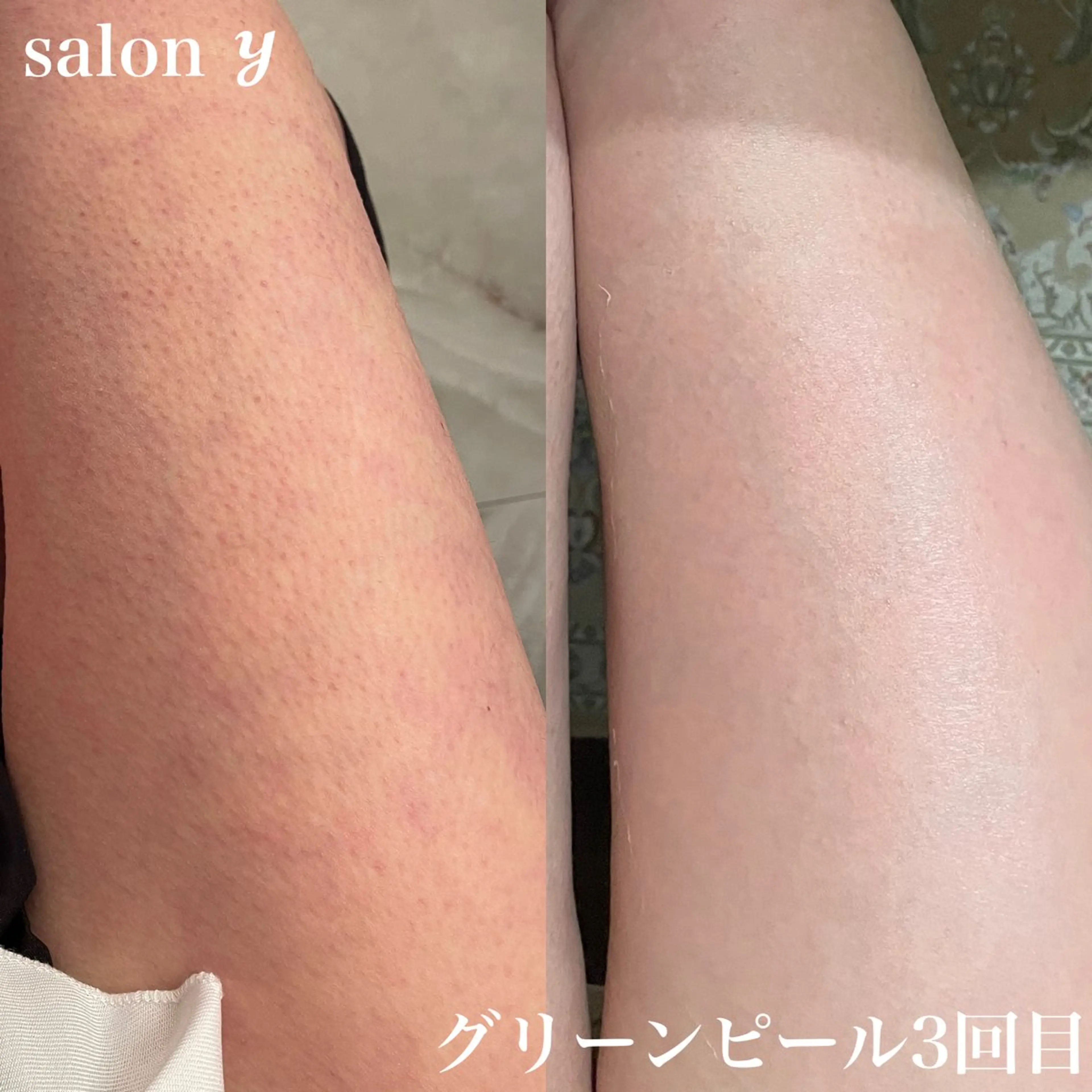 グリーンピールボディ1day(1パーツ)【体のざらつきをスベスベに！】の写真