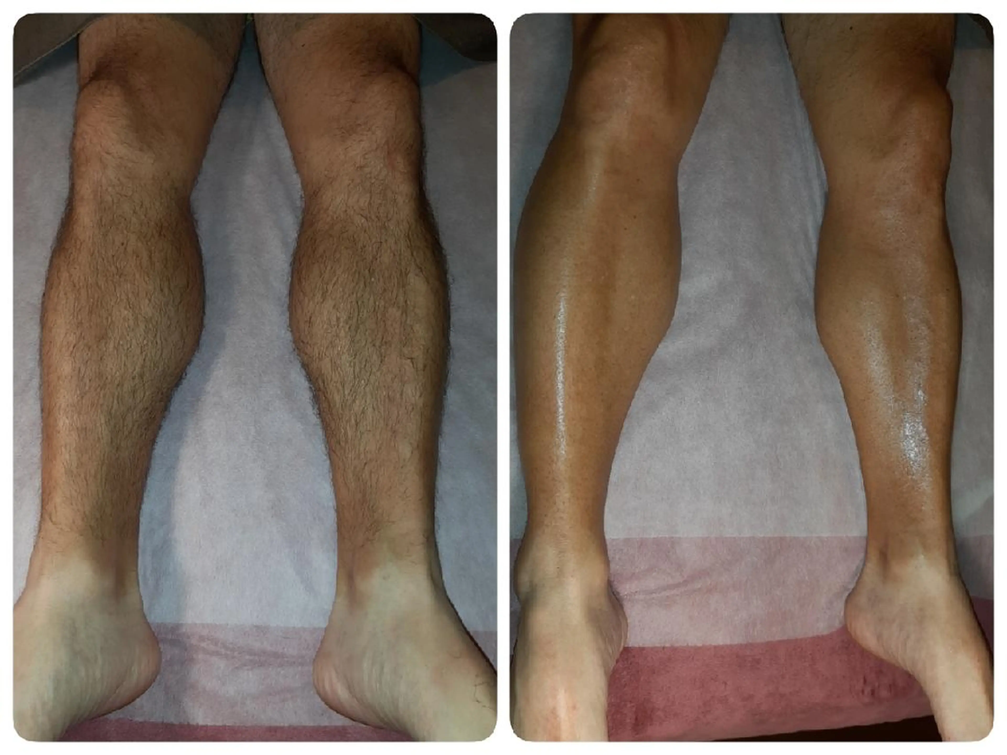 脚丸ごとワックス脱毛or光脱毛どちらかの写真