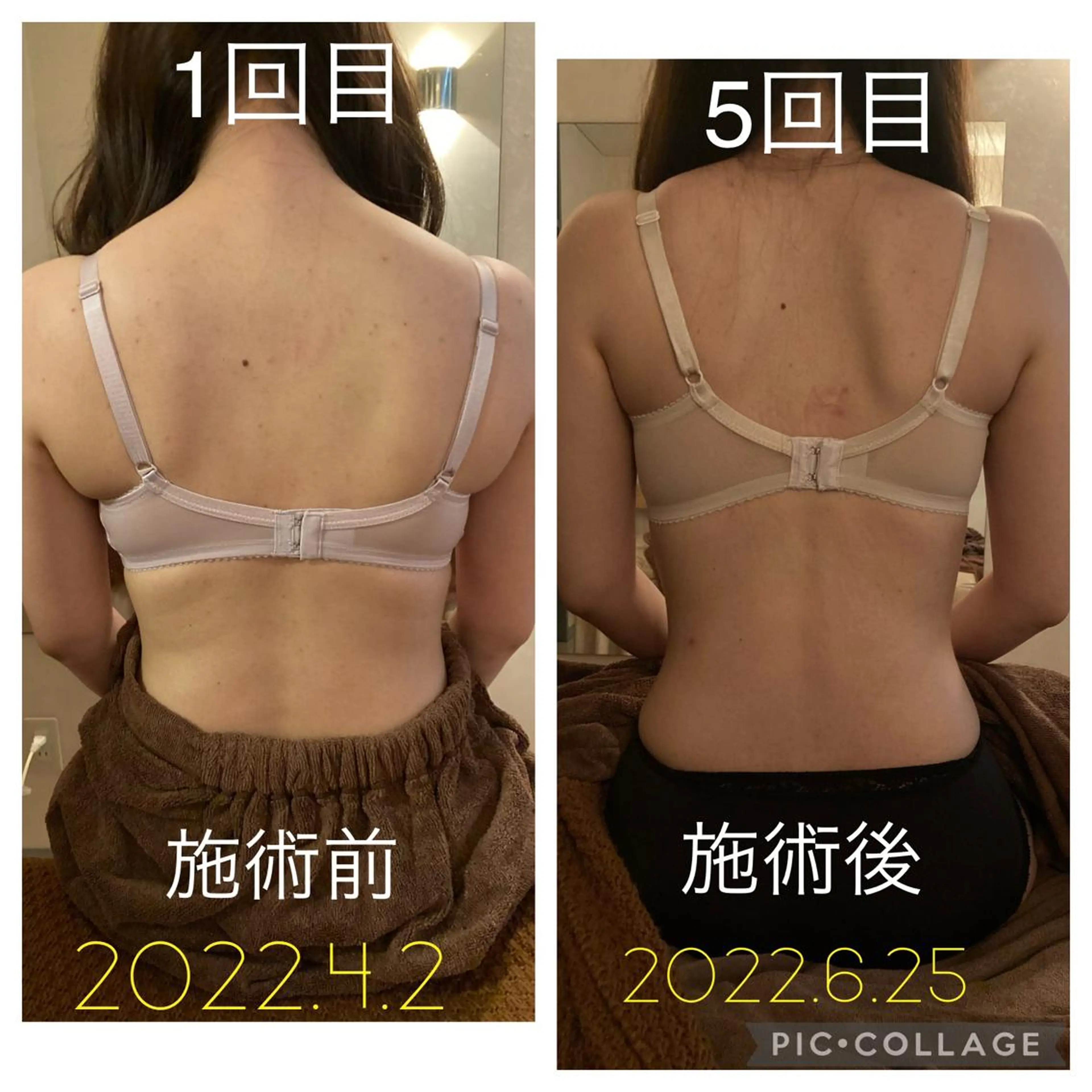 背中のぷよぷよが気になる！後ろ姿を美しくしたい方！美ボディメイク！背中はほっそりくびれもできちゃう1回で感動の結果💓の写真